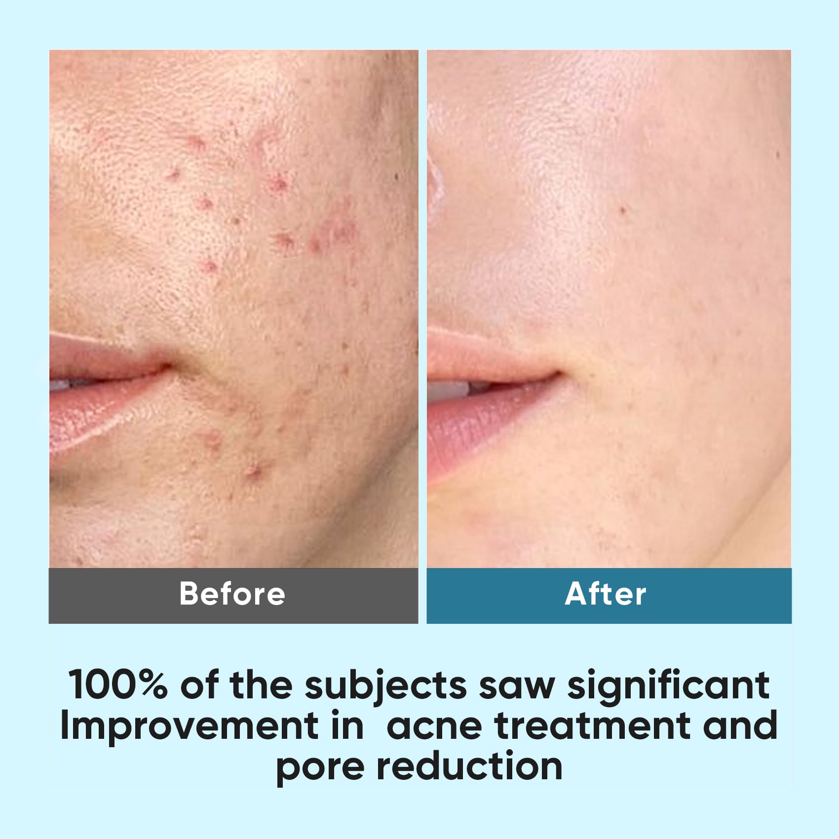 Elvira Korean Skincare Anti-Aging & Glycolic Acid Exfoliating Facial Pads With 10% Glycolic Acid, 2% Salicylic Acid & Niacinamide - 60 Toner Pads, Daily Peel Treatment for Acne Prone Sensitive Skin