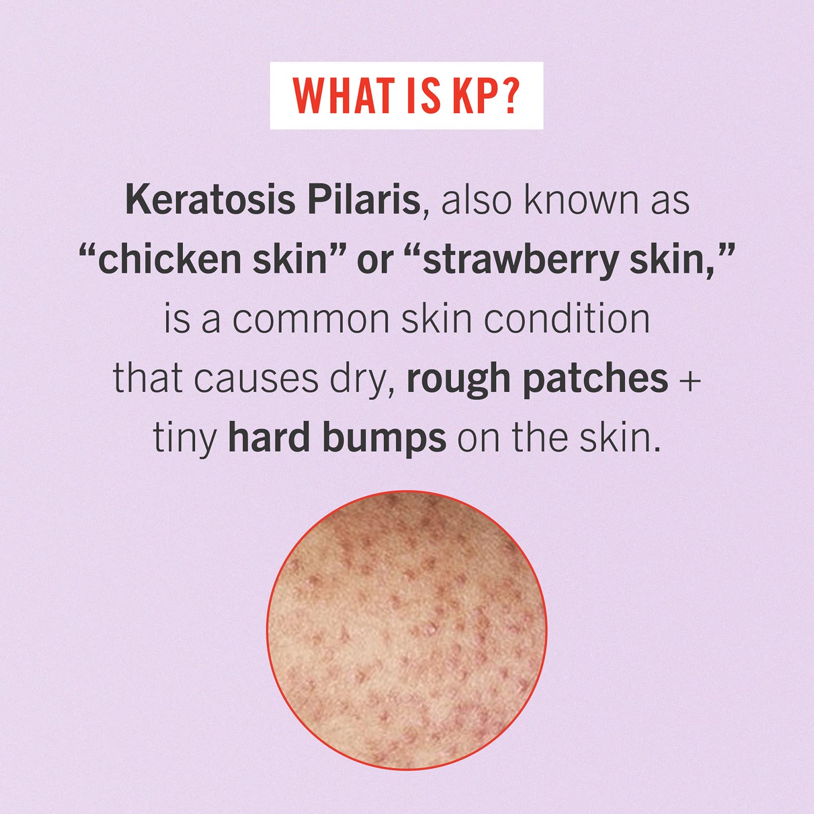 First Aid Beauty - Smooth Operators Trio: KP Bump Eraser Body Scrub, 8 oz, Smoothing Lotion, 6oz, and Ingrown Hair Pads, 28 Pads, Deep Moisture Exfoliating Skin Treatment Set with BHA & AHA, 3ct