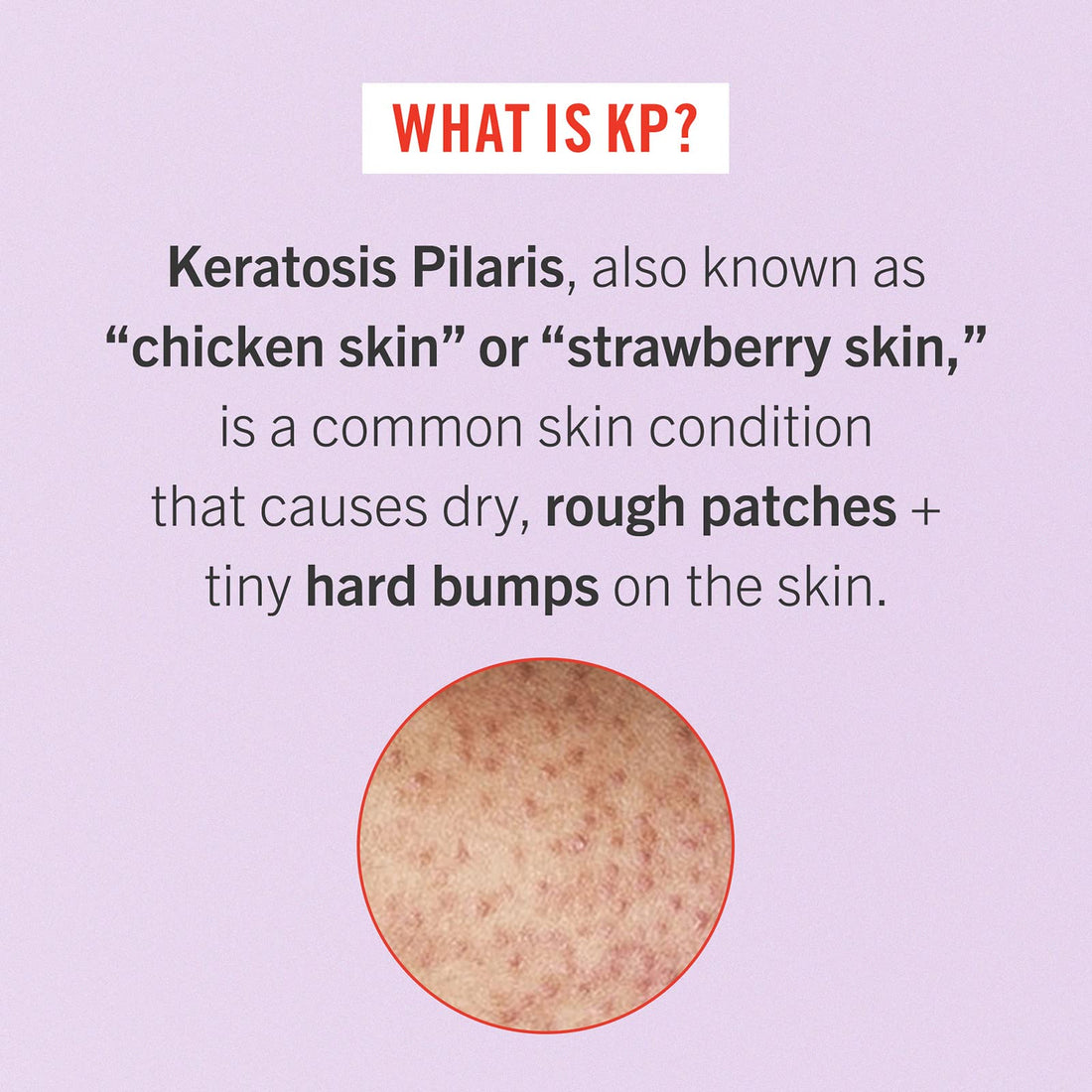 First Aid Beauty - Smooth Operators Trio: KP Bump Eraser Body Scrub, 8 oz, Smoothing Lotion, 6oz, and Ingrown Hair Pads, 28 Pads, Deep Moisture Exfoliating Skin Treatment Set with BHA & AHA, 3ct