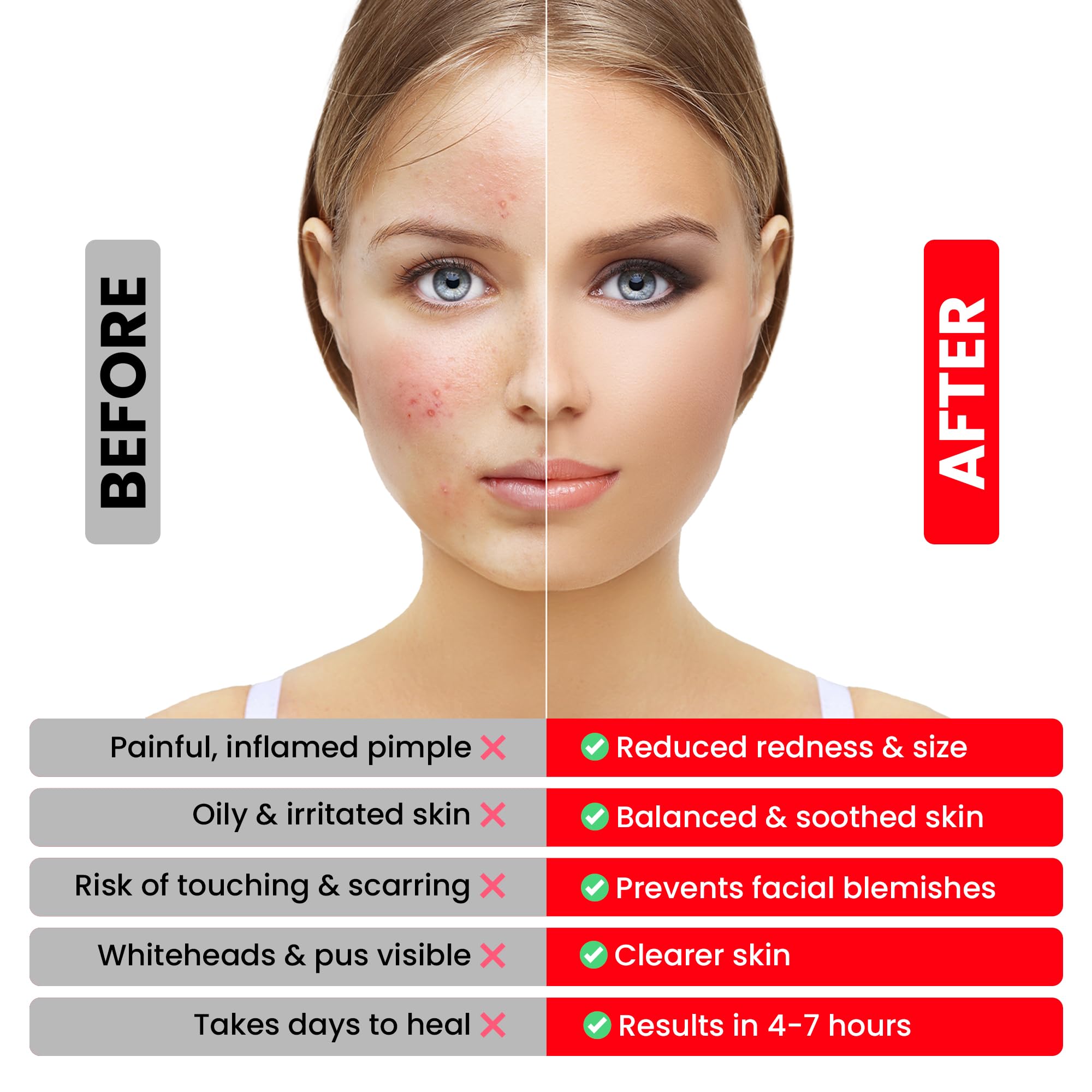 Acne & Pimple Patches – Profeccional Hydrocolloid Acne Patches for Fast Blemish & Zit Removal | Pimple Spot Treatment for Face & Skin | Vegan, Cruelty-Free | 180 Count