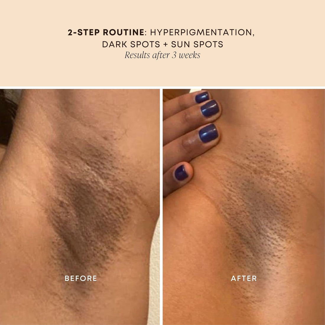 Bushbalm Dark Spot Oil - Improve Appearance of Dark Spots, Ingrown Hair All Over Body, soothe, Rejuvenate and Nourish, Bermuda Oil - 30ml