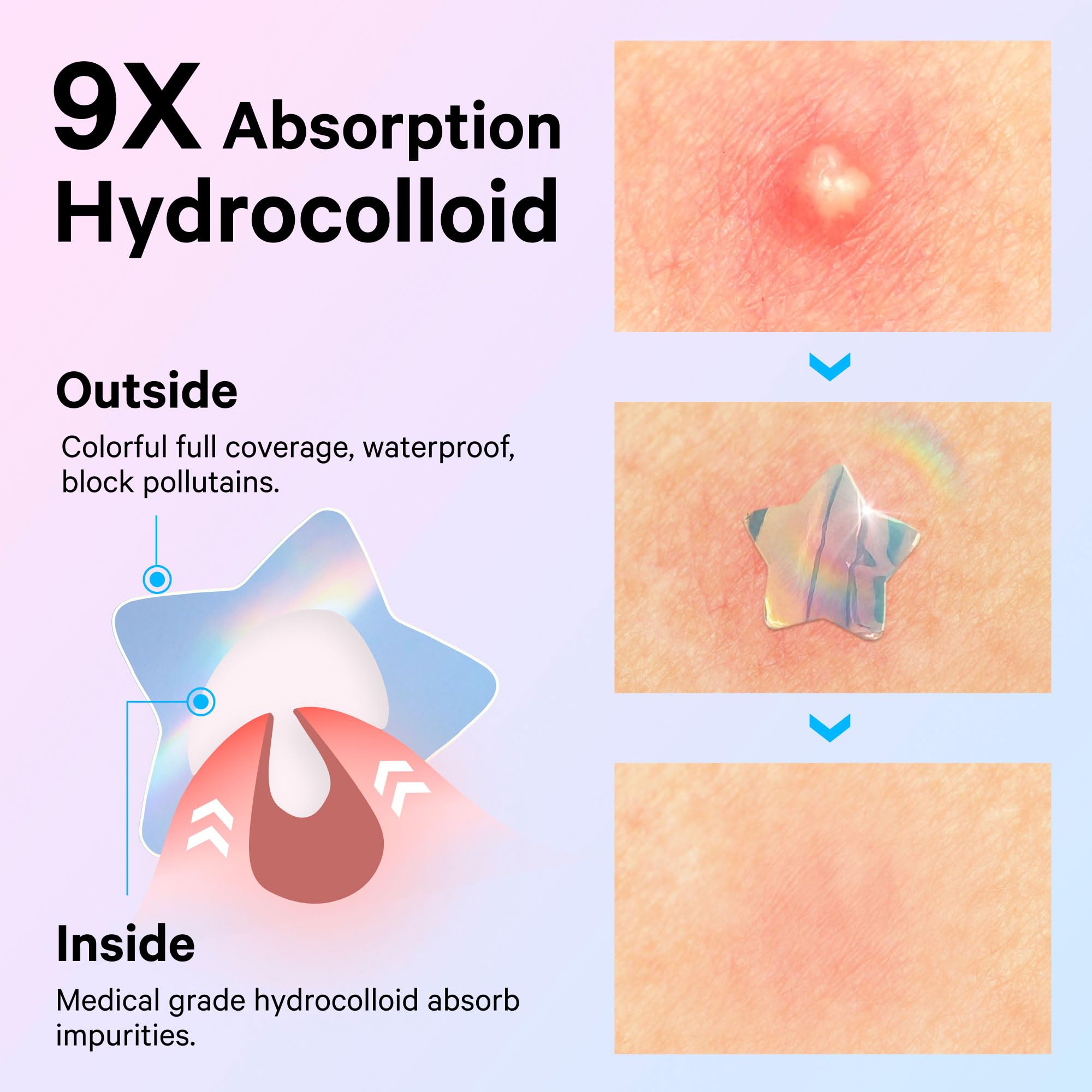 Sosky Hologram Pimple Patches for Face, Hydrocolloid Acne Patches with Salicylic Acid, Cute Star Zit Stickers,Colorful Blemish Covers,48 Count Blue Pink Star Moon Cloud Butterfly