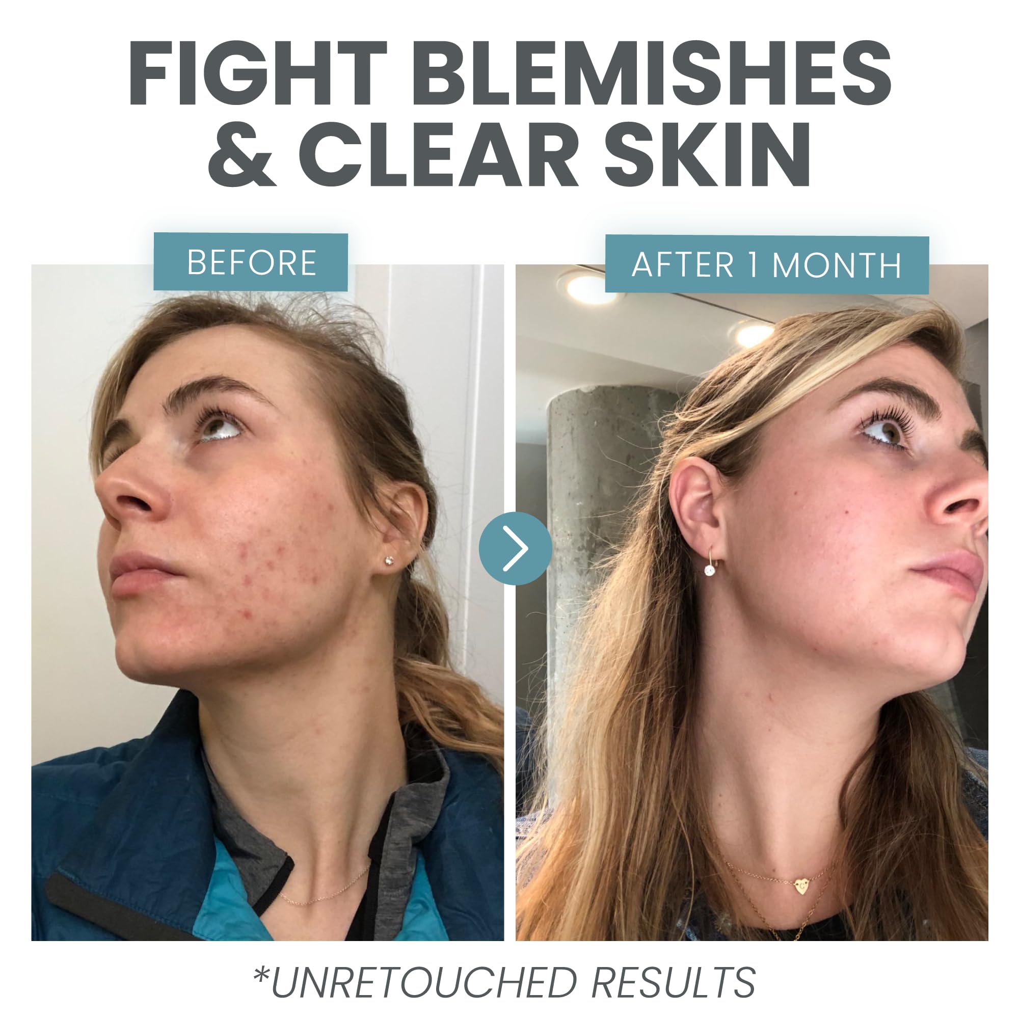 Vitamin C Serum for Face with Retinol & Salicylic Acid – Skin Clearing Acne Spot Treatment with Niacinamide, Hyaluronic Acid, MSM – Anti-Aging Facial Serum for Dark Spots and Blemishes