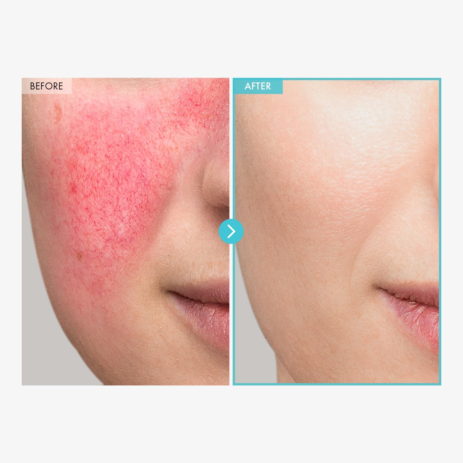 TOSOWOONG SOS Repair CICA Clinic Zinc Cream, 100,000ppm Zinc Oxide, Heal, Soothe Acne, Redness, Rosacea, Skin Barrier Repair, Moisture Barrier Cream, Non-Comedogenic, Korean Skin care, 50g, 1.76 oz.