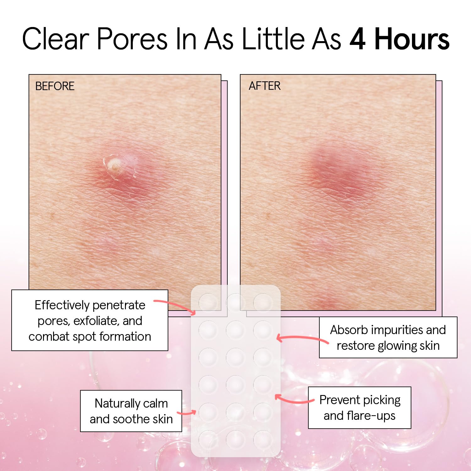 grace & stella Award Winning Pore Strip - Pimple Patches for Face - Hydrocolloid Acne Patches for Shrinking Zits, Breakouts - Spot Stickers - Dermatologist-Tested, Vegan (Invisible, 36 Count)