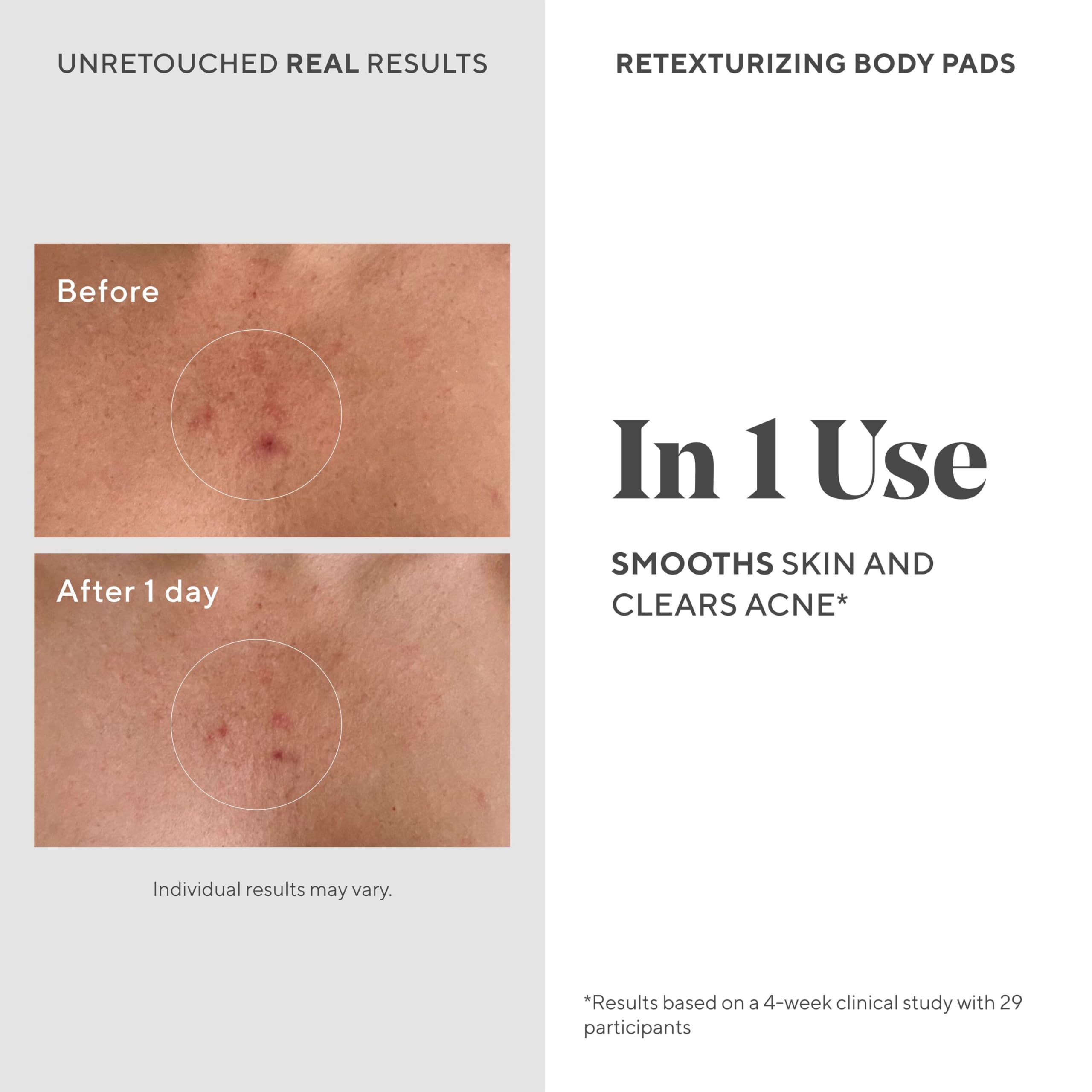 Murad Acne Retexturizing Face & Body Pads - Smooth + Soothe - with Azelaic + Bacteria-Targeting Multi-Acids to Soothe Irritation, Redness, and Providing Oil-Free Hydration, 45Pc