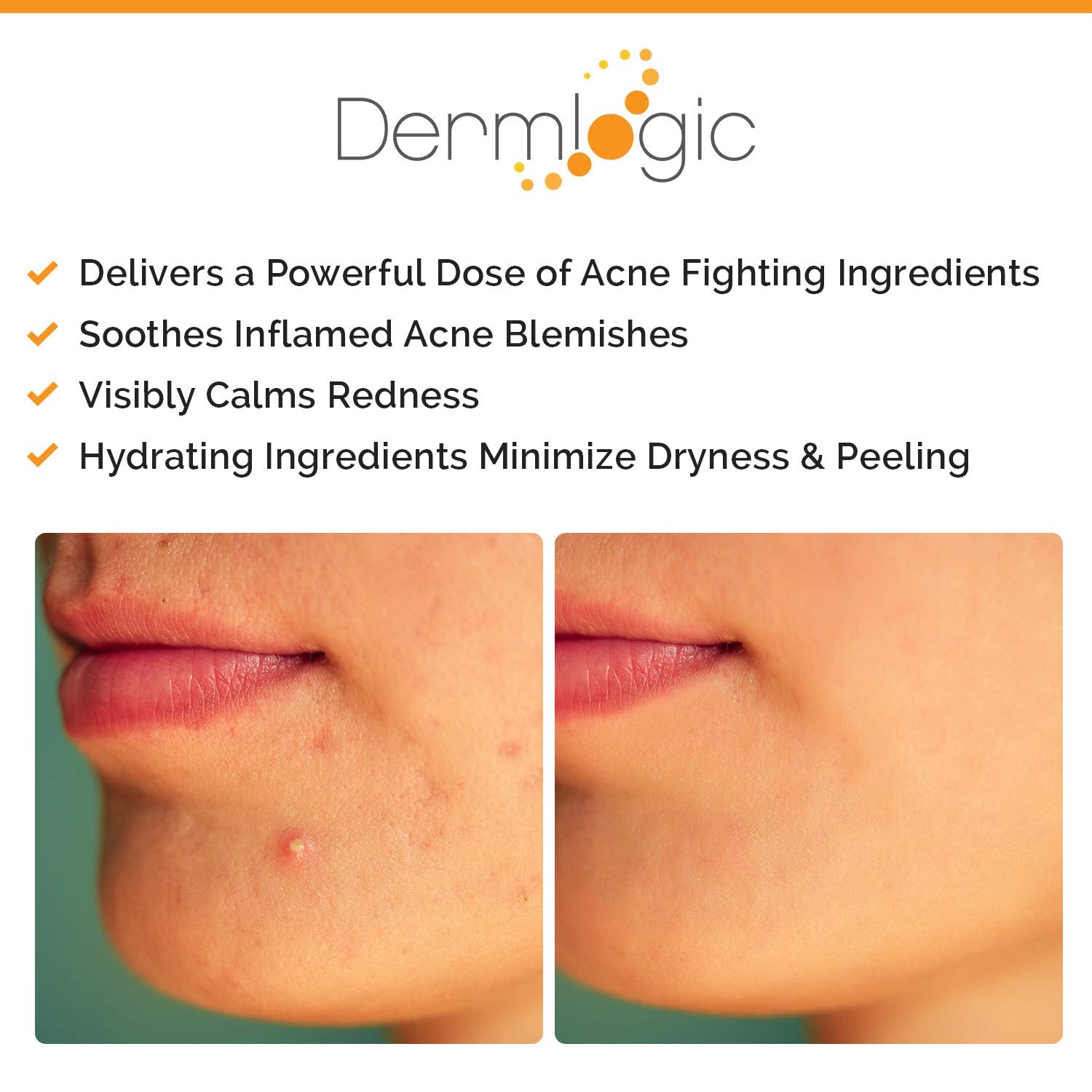 Acne Spot Treatment- Overnight Treatment for Whitehead & Blackhead Pimples. Eliminate Cystic Breakouts & Clogged Pores. Clears Away Severe, Mild, Moderate Blemishes for Teens & Adults. Alcohol-Free.