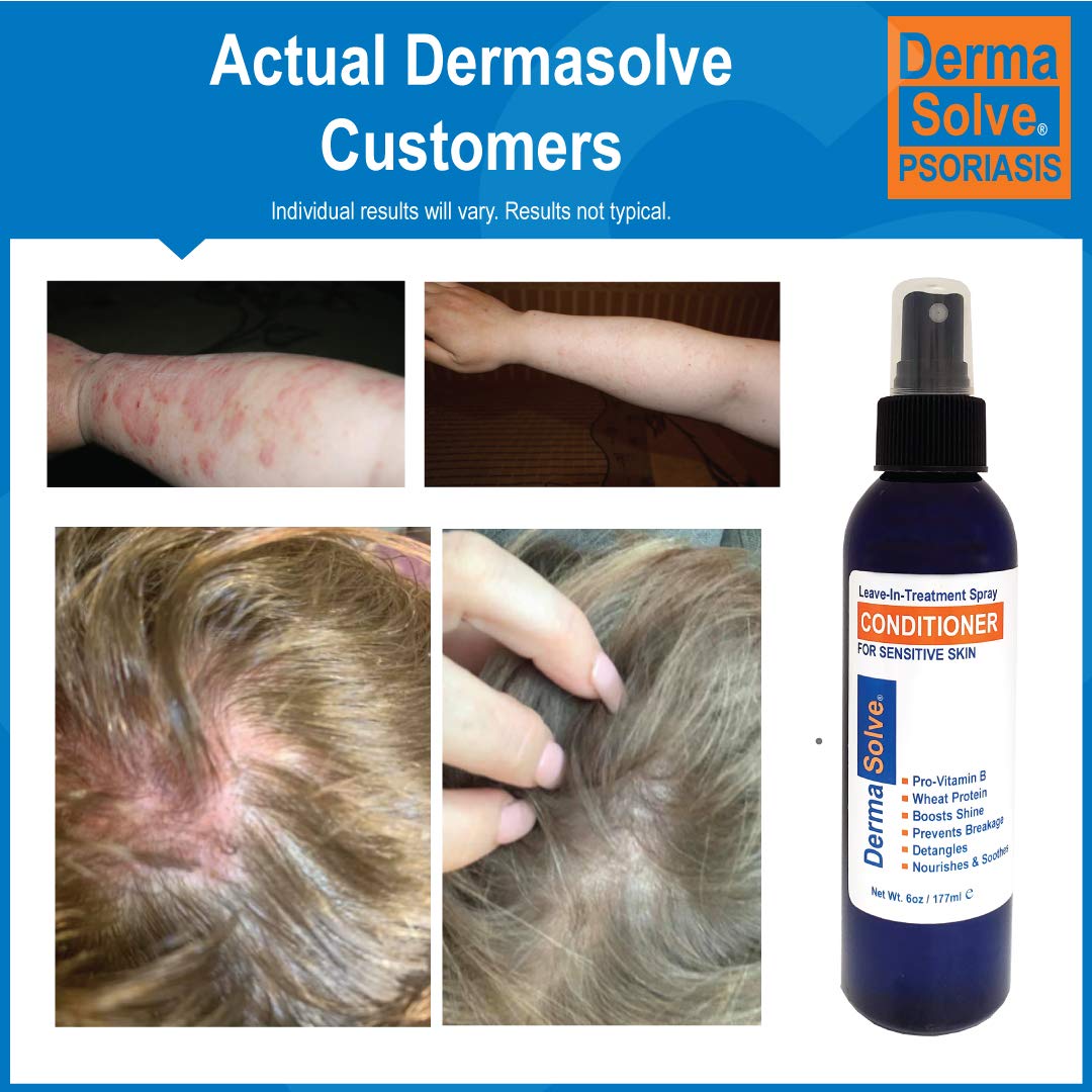 Dermasolve Psoriasis Leave-In-Treatment and Styling Spray Conditioner for Seborrheic Dermatitis, Sensitive Skin, Detangle, De-Flake, Soothing Anti Dandruff, Dry Scalp Repair for Damaged Hair