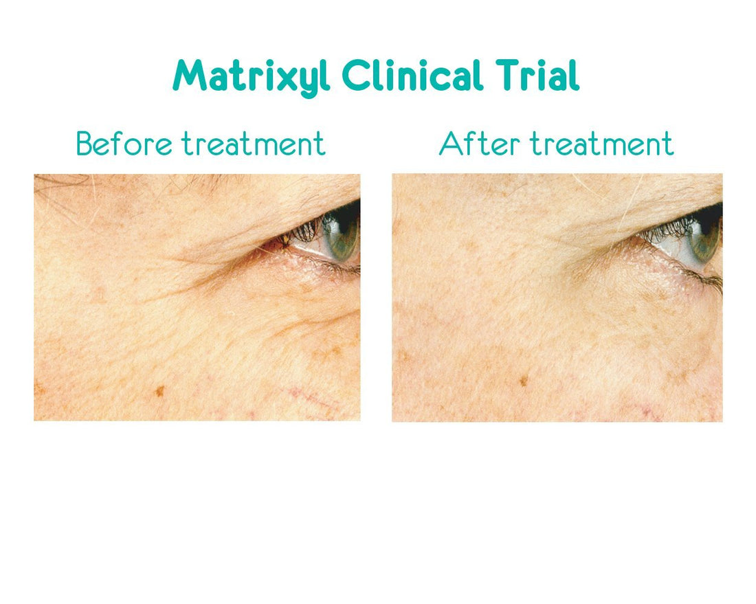 Moisturizing ANTI WRINKLE CREAM For Your Face & Neck - HYALURONIC ACID + ARGIRELINE + MATRIXYL - This Peptide Cream has the Best *** Clinically Proven *** Ingredients To Reduce Fine Lines & Deep Wrinkles. All-In-One Night & Day Cream Moisturizer & An