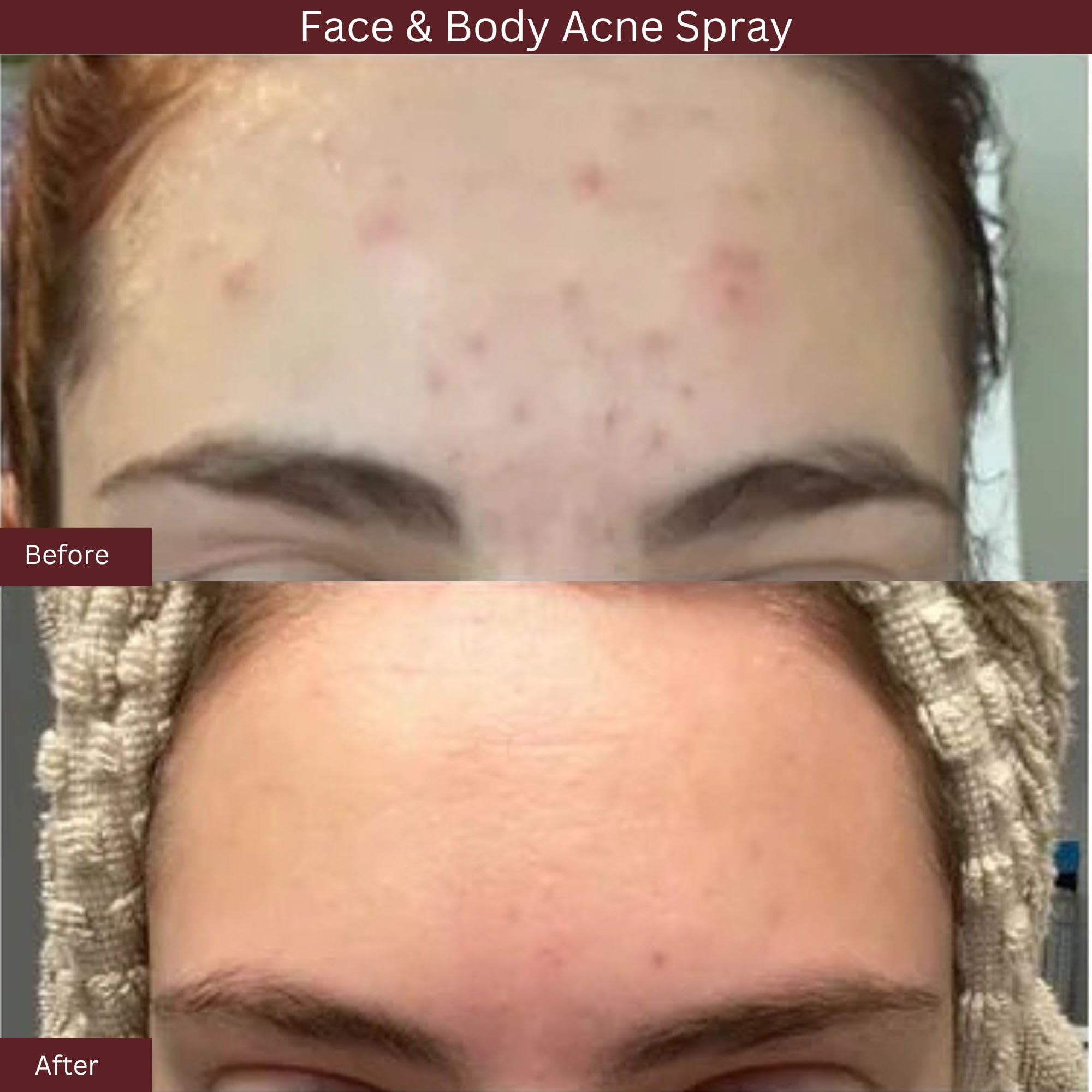 ITK Skincare 2% Salicylic Acid Spray for Face & Body Acne - Blemish-Fighting Treatment for Body Acne, Bacne, Blackheads, Pimples & Blemishes - BHA Blemish Facial Mist Post Workout - 3.3oz Spray Bottle