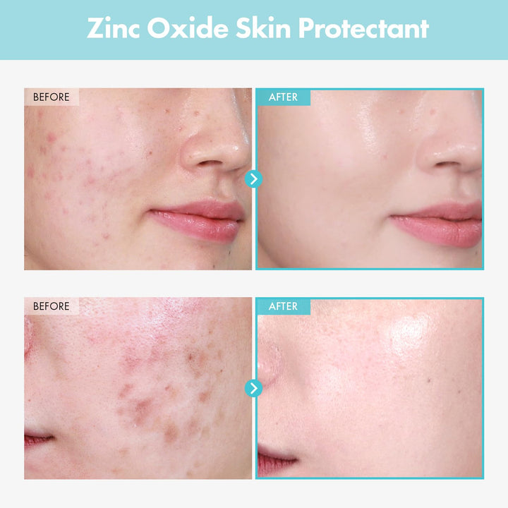 TOSOWOONG SOS Repair CICA Clinic Zinc Cream, 100,000ppm Zinc Oxide, Heal, Soothe Acne, Redness, Rosacea, Skin Barrier Repair, Moisture Barrier Cream, Non-Comedogenic, Korean Skin care, 50g, 1.76 oz.
