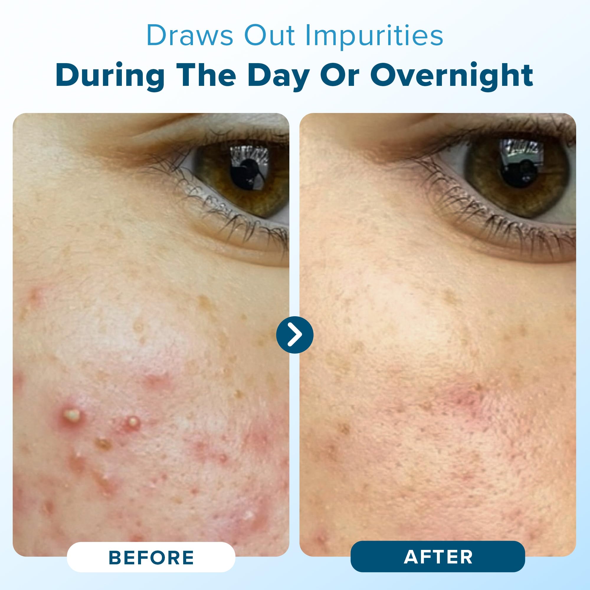 Hydrocolloid Pimple Patches (Made in Korea) FSA/HSA Eligible - Vegan, Hypoallergenic, Cruelty-Free Acne Circle Stickers for Overnight Use, for Zits, Spots, Pimples, Whiteheads (46 Count, Mixed Sizes)