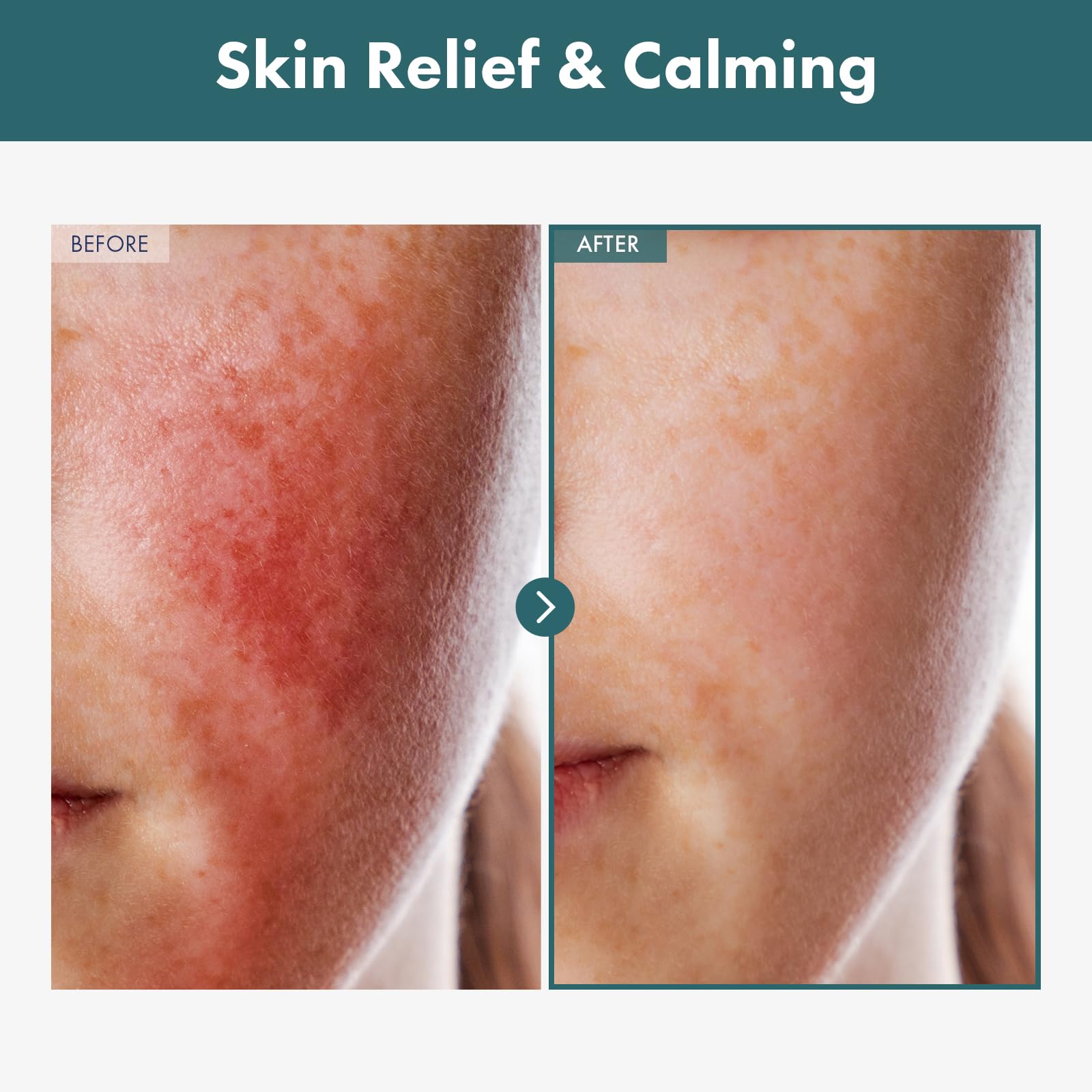 TOSOWOONG Adenosine Cica Cream, 520,000ppm Centella Asiatica, Redness Reducing for Oily and Dry Skin Moisturizer, Barrier Cream with Niacinamide and Panthenol, Korean Skincare, 100ml, 3.38 fl. oz.