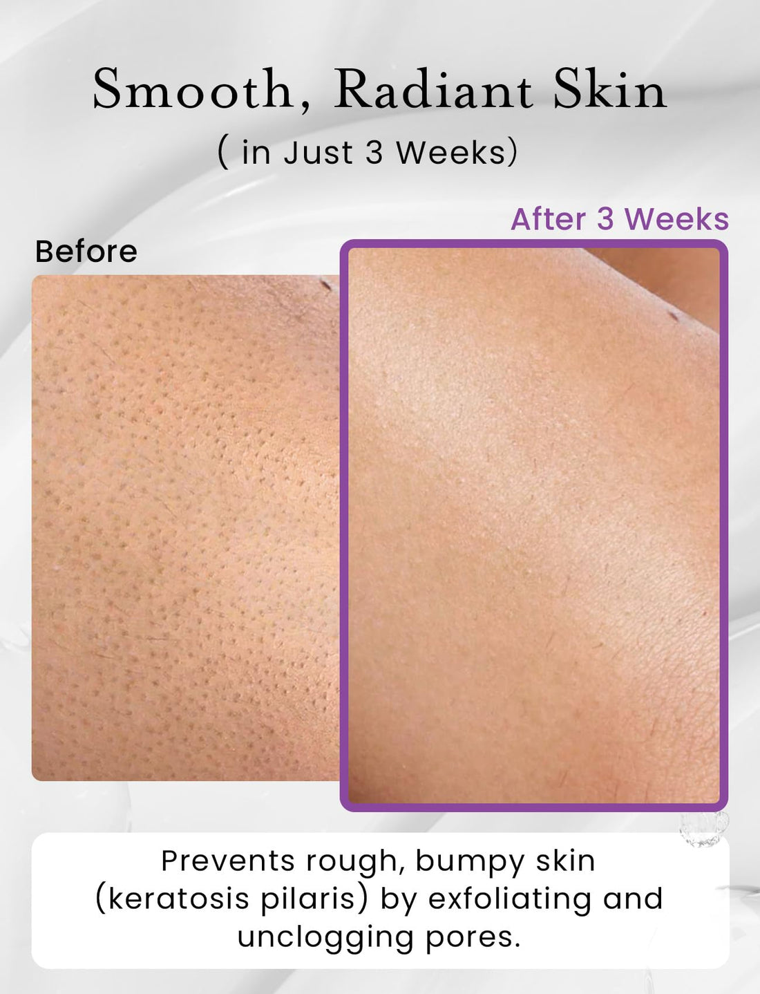 Elvira KP Bump Eraser Foot & Body Scrub, Exfoliating Scrub for Keratosis Pilaris, Smooth Skin with 10% AHA BHA & Niacinamide, Deep Moisturizing Cleanser for All Skin Types, Exfoliante para el Cuerpo