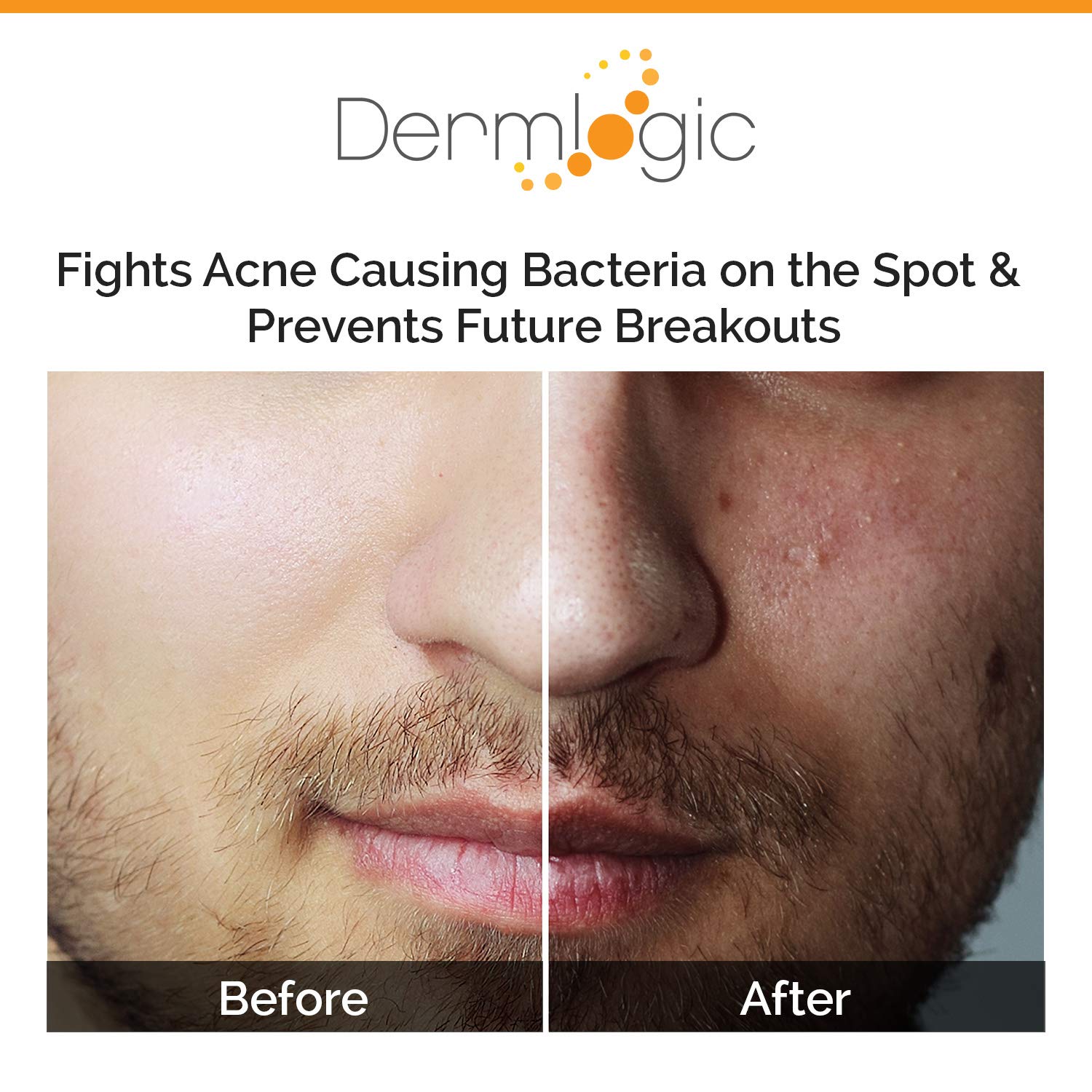 Acne Spot Treatment- Overnight Treatment for Whitehead & Blackhead Pimples. Eliminate Cystic Breakouts & Clogged Pores. Clears Away Severe, Mild, Moderate Blemishes for Teens & Adults. Alcohol-Free.