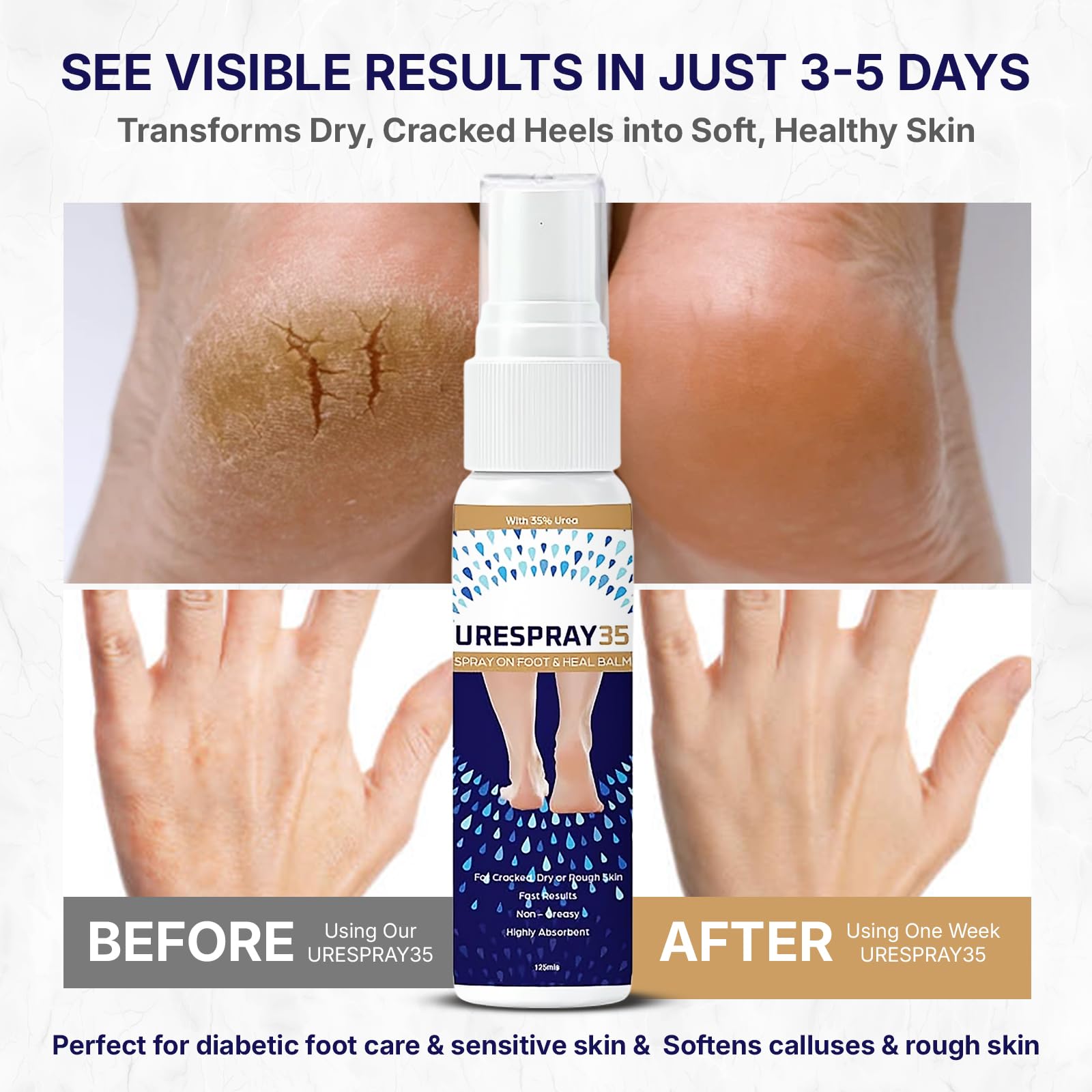 URESPRAY 35% Urea Foot & Heel Spray - 125ML Moisturizing Treatment for Dry, Cracked Feet, Heels, Knees & Elbows - Intensive Skin Repair, Callus Remover, Dead Skin Care & Cuticle Softener Spray