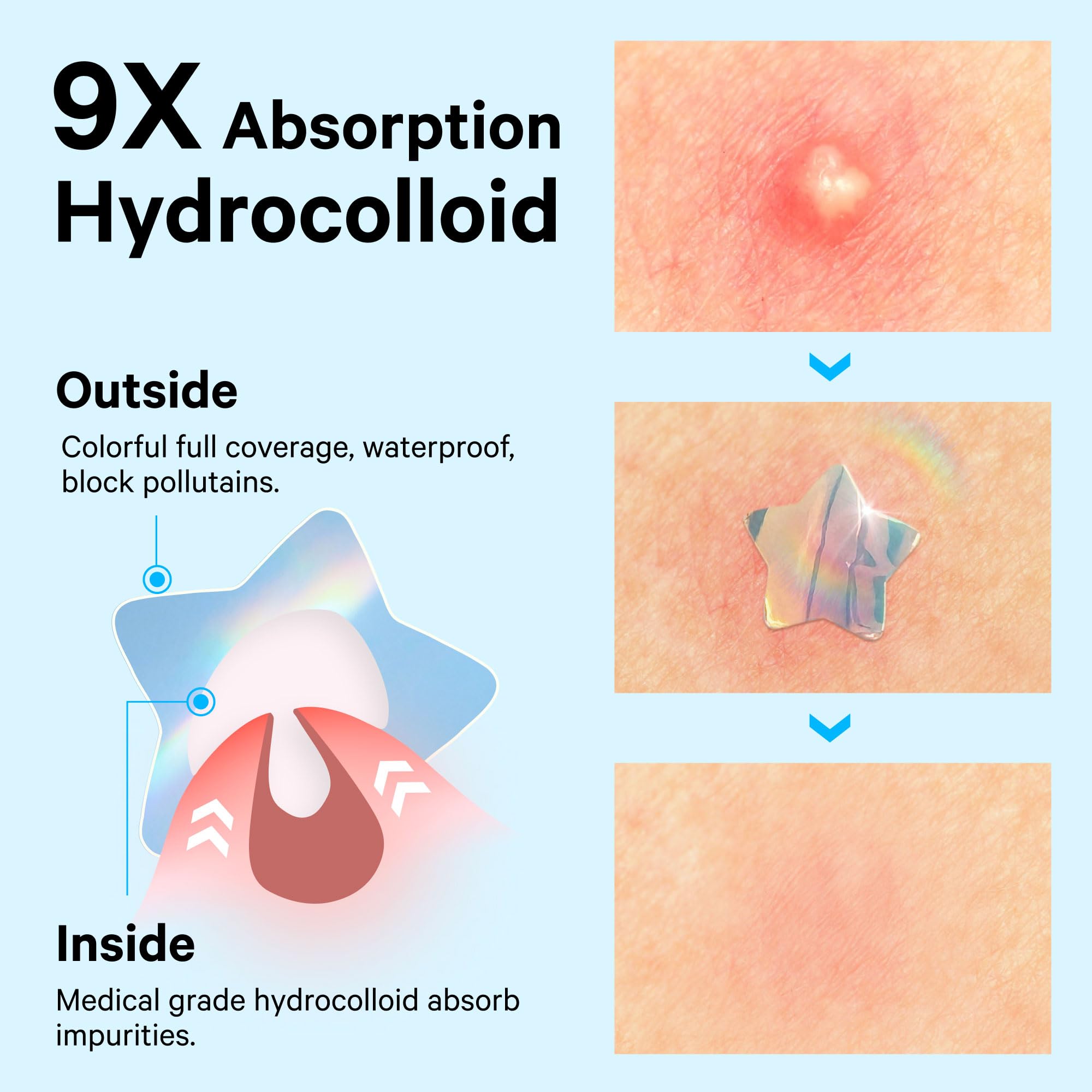 Sosky Hologram Pimple Patches for Face, Hydrocolloid Acne Patches with Salicylic Acid, Cute Star Zit Stickers,Colorful Blemish Covers,36 Count Blue Star Cloud Butterfly