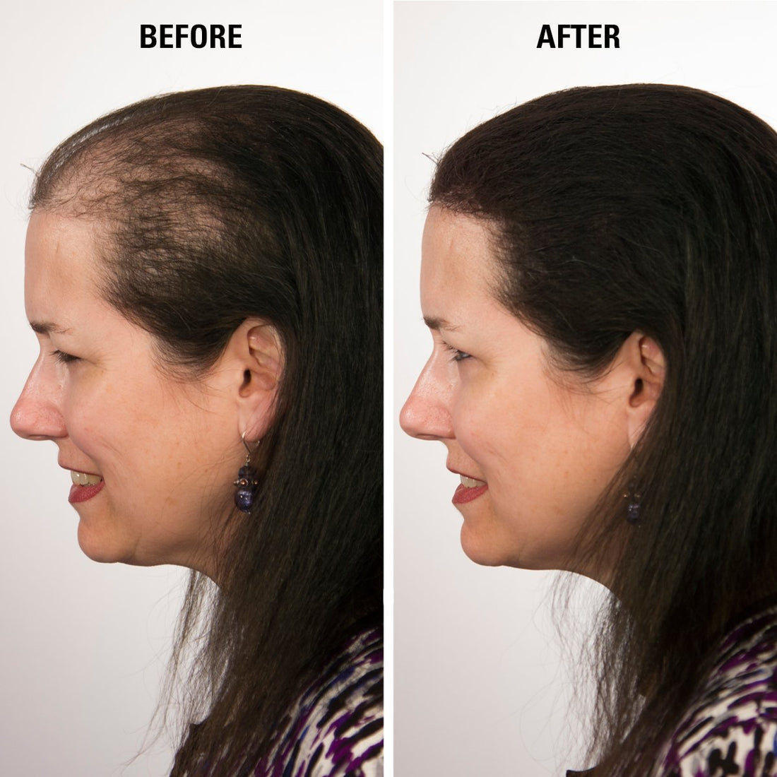 Infinity Hair Fibers for Thinning Hair (WHITE) For Women & Men - 100% Undetectable Fibers - 30g Bottle - Completely Conceals Hair Loss in 15 Seconds