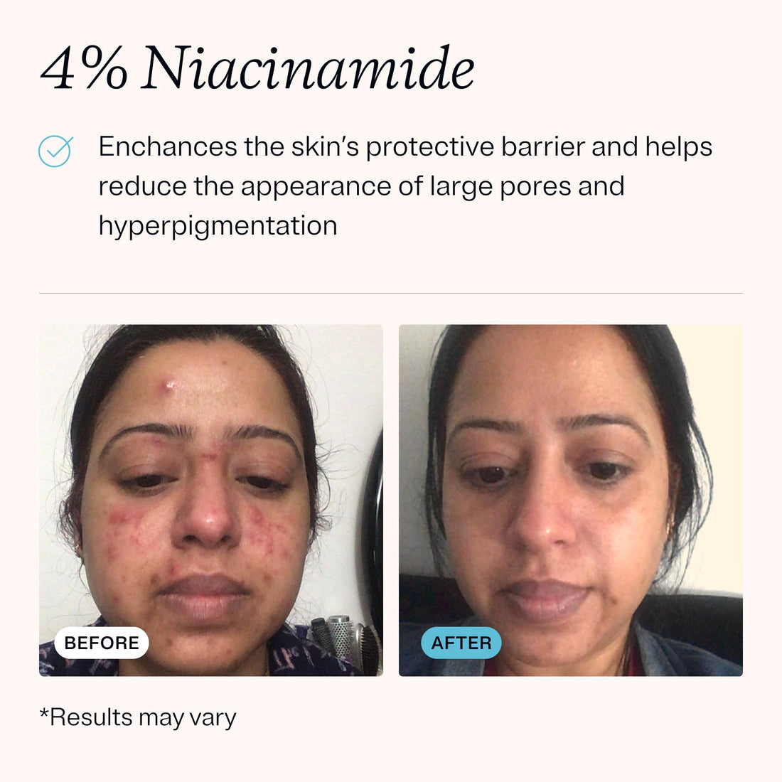 MDacne – Retinol 0.5% and Niacinamide 4% Cream, Reduces Blemishes and Improves Skin Texture without Irritation