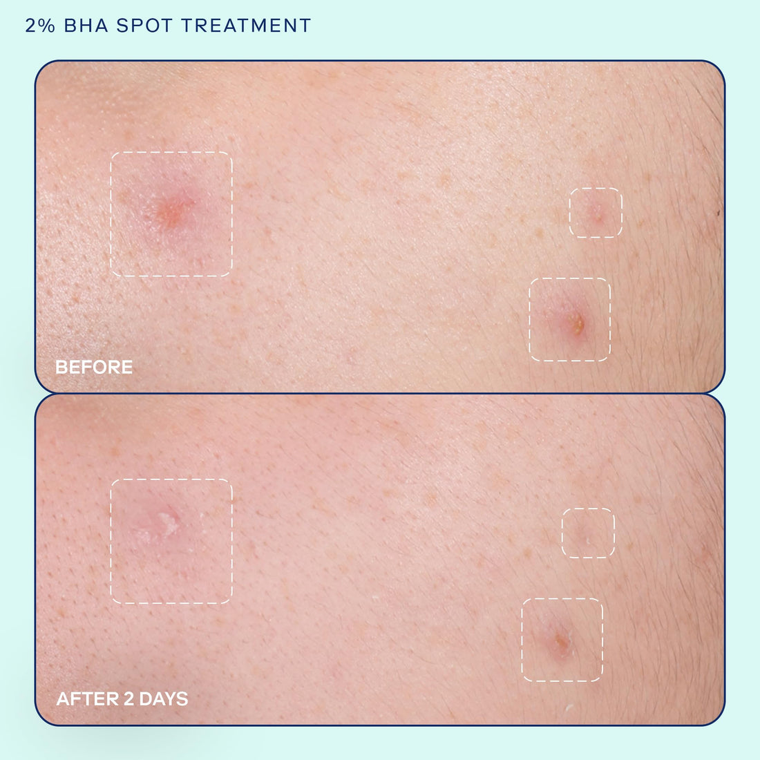 Skinfix Acne+ 2% BHA Acne Spot Treatment: Clinical-Strength, Rapid-Acting Acne Treatment that Reduces Blemish Size and Redness, Plus Prevents New Acne Pimples from Forming, 0.5 oz