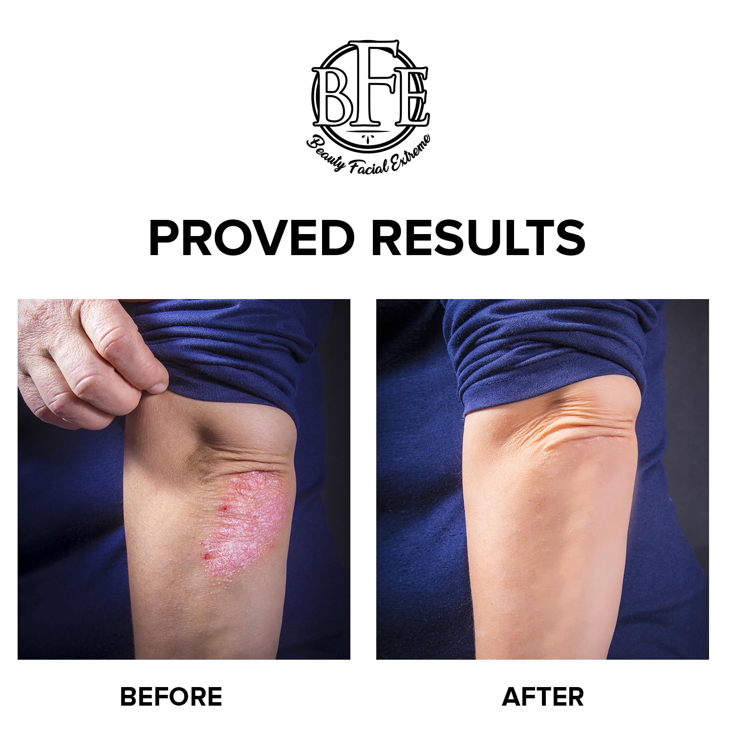 Keratosis Pilaris Exfoliating Body Lotion– 12% Lactic Acid. Provides Immediate Moisture & Gentle Exfoliation to Treat symptoms Associated with Keratosis Pilaris & Dry, Bumpy Skin Conditions.