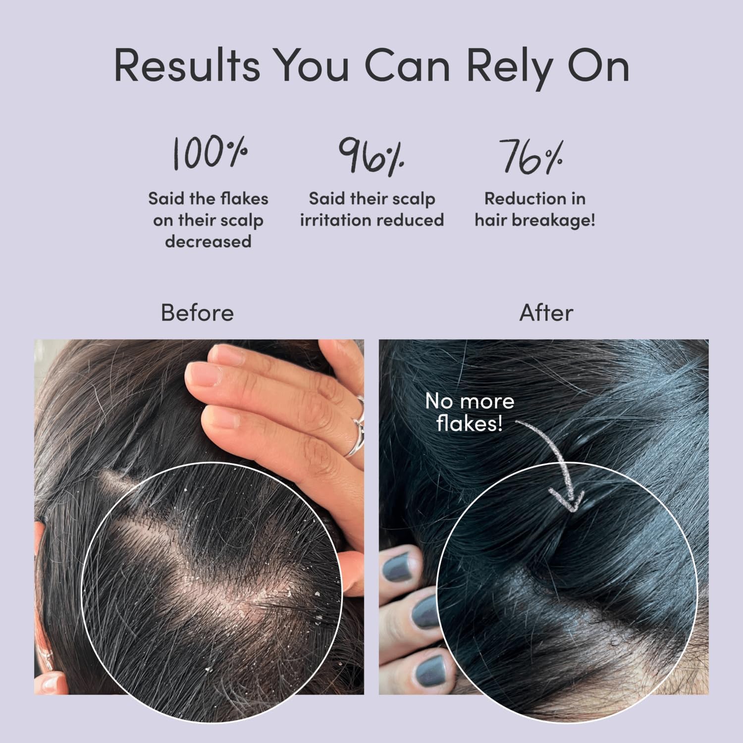 Jupiter Anti-Dandruff Shampoo, for Women & Men, Physician-Formulated for Flaky, Itchy, Oily, Dry Scalp, Vegan, Sulfate-Free, Color-Safe, & Paraben-Free, Anti-Dandruff Shampoo with Zinc, 9.5 fl oz