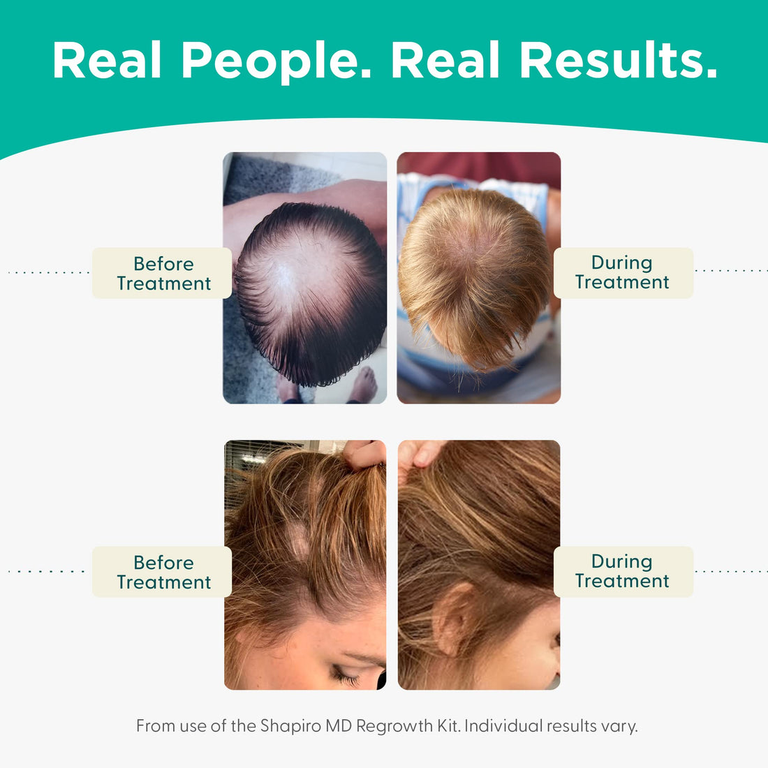 Shapiro Md Shampoo And Conditioner Containing The 3 Most Powerful, All-Natural Dht Blockers For Thicker, Fuller, And Healthier Hair (1 Month Supply)