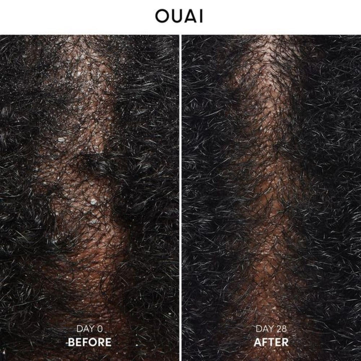 OUAI Anti Dandruff Shampoo - Soothing Salicylic Acid Shampoo for Flaky, Dry and Itchy Scalp - Reduces Itching, Redness and Irritation - Sulfate Free Scalp Care (10 Fl Oz)