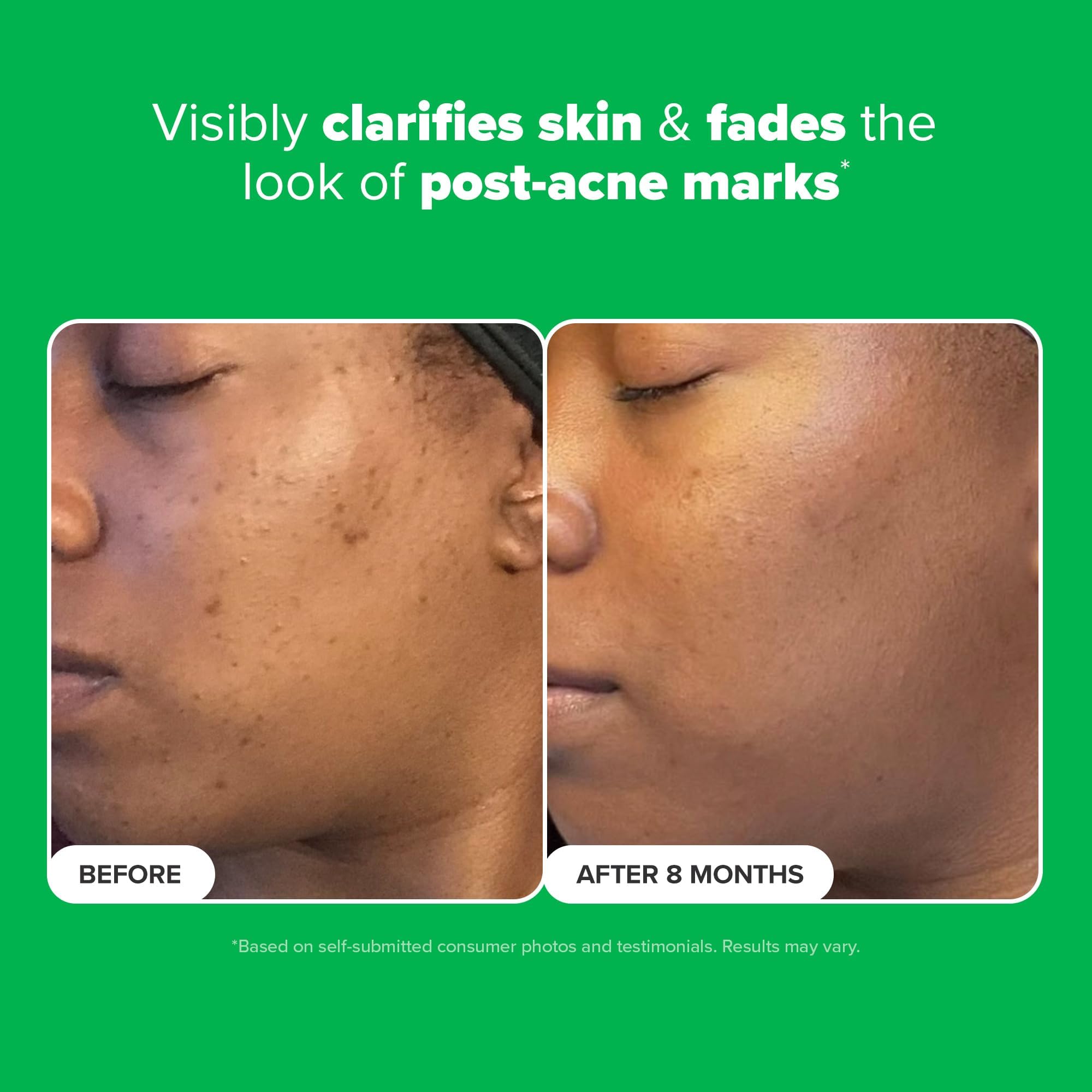 Paula's Choice BOOST 10% Azelaic Acid Booster Cream Gel, Licorice Extract & Salicylic Acid, Oil-Free Skin Brightening Serum, 1 Ounce