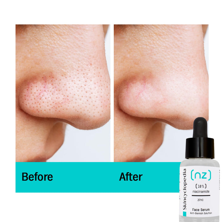 Skincyclopedia Pure Niacinamide & Zinc Face Serum, Anti Blemish Solution & Pore Minimizer, Acne Control & Oil Balancing, Clears Acne Marks & Blemishes
