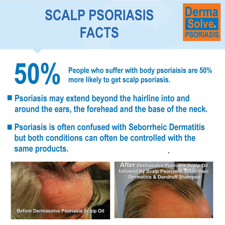 Scalp Psoriasis Shampoo & Conditioner (2-pack) Naturally Heals Dandruff Seborrheic Dermatitis Itchy Flakey Inflamed Skin and Provides Soothing Moisturizing Relief - two 8 oz bottles by DermaSolve