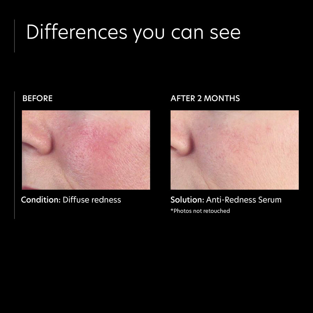PCA Skin Anti-redness Serum (Phaze 42), 1 Fluid Ounce