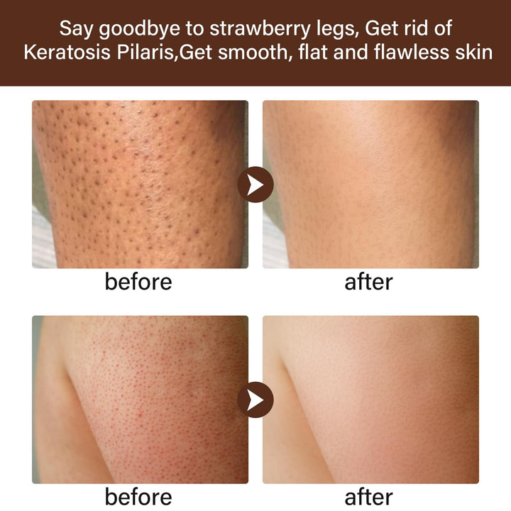 Strawberry Legs Treatment For Women, Rough Bumpy Body Cream, Lotion For Dry Skin Strawberry Skin Remover, Keratosis Pilaris Treatment Moisturizing Cream Body Moisturizer for Spots Brightening Dry