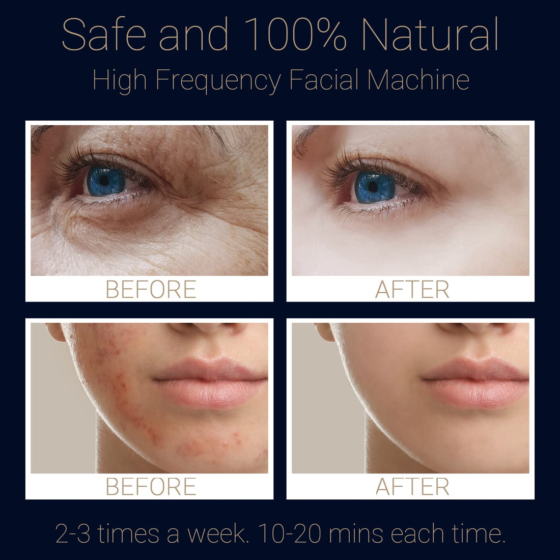 High Frequency Facial Wand - UUPAS 6 in 1 Portable High Frequency Facial Skin Machine Device with 6 Pcs of High Frequency Blue Different Glass Tubes for Face/Eyes/Body