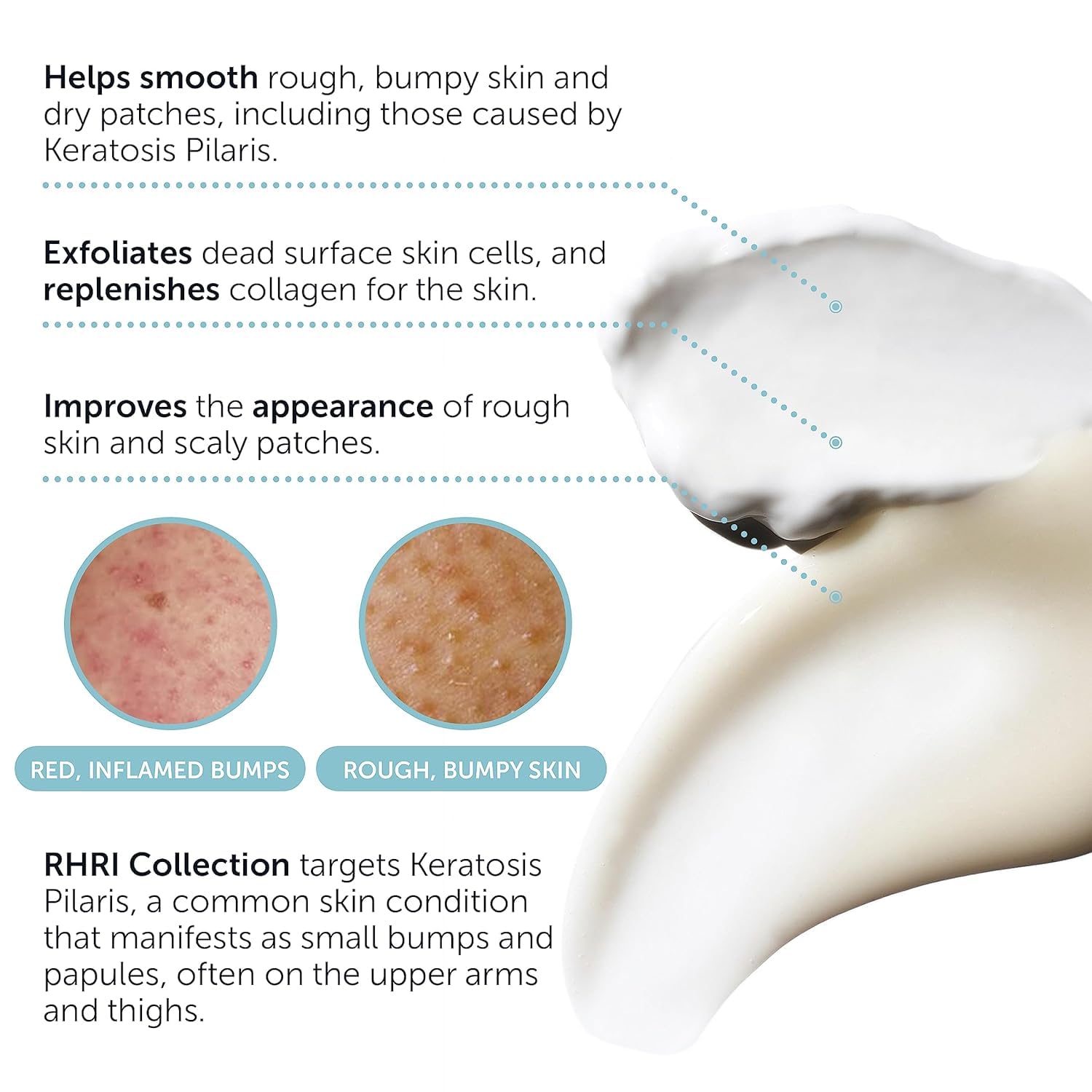 KP Bump Eraser Body Scrub + Keratosis Pilaris Lotion Bundle Set, Strawberry Legs Treatment for Women, Bump Eraser Body Scrub