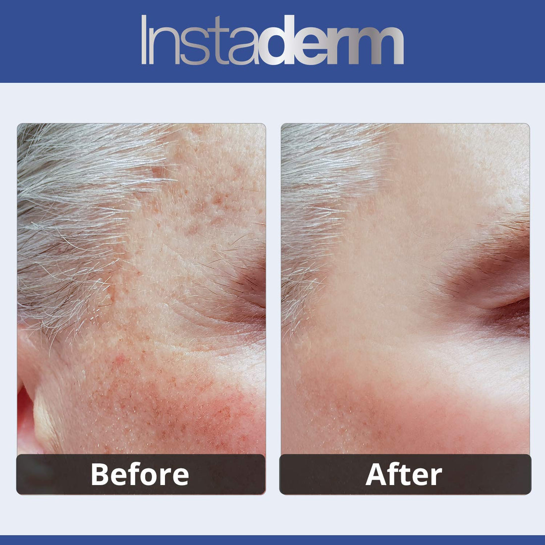 Instaderm Anti Aging Dark Spot Corrector Cream- Naturally Fades Dark Spots, Sun Spots, Age Spots, Acne Blemish Scars, Brown Spots & Freckles for Brighter Lighter Hydrated Looking Skin.
