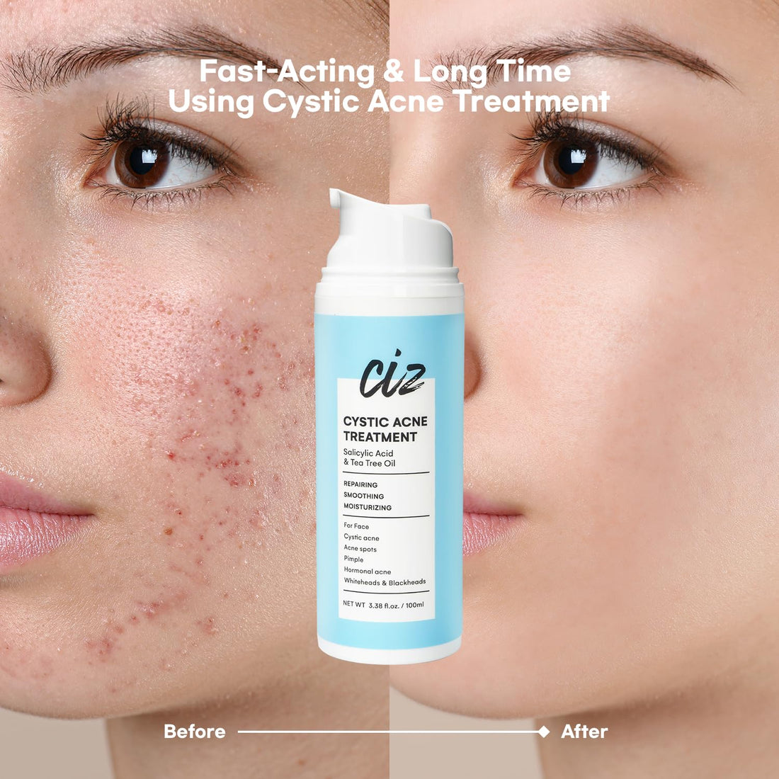 Cystic Acne Spot Treatment for Face: Hormonal Acne Pimple Cream with Salicylic Acid & Tea Tree Oil - Hormonal & Pimple Cream for Teens & Adults,120 Day Supply & 3.38 oz / 100 ml