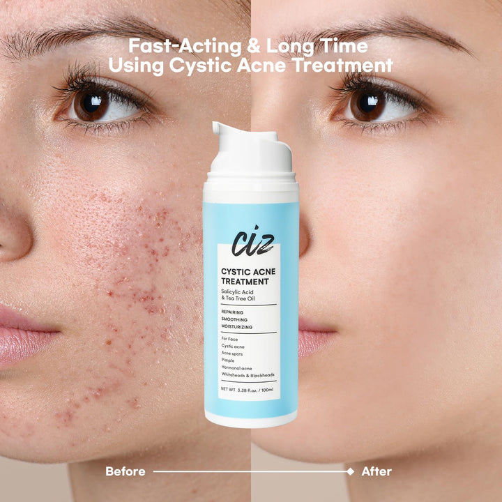 Cystic Acne Spot Treatment for Face: Hormonal Acne Pimple Cream with Salicylic Acid & Tea Tree Oil - Hormonal & Pimple Cream for Teens & Adults,120 Day Supply & 3.38 oz / 100 ml