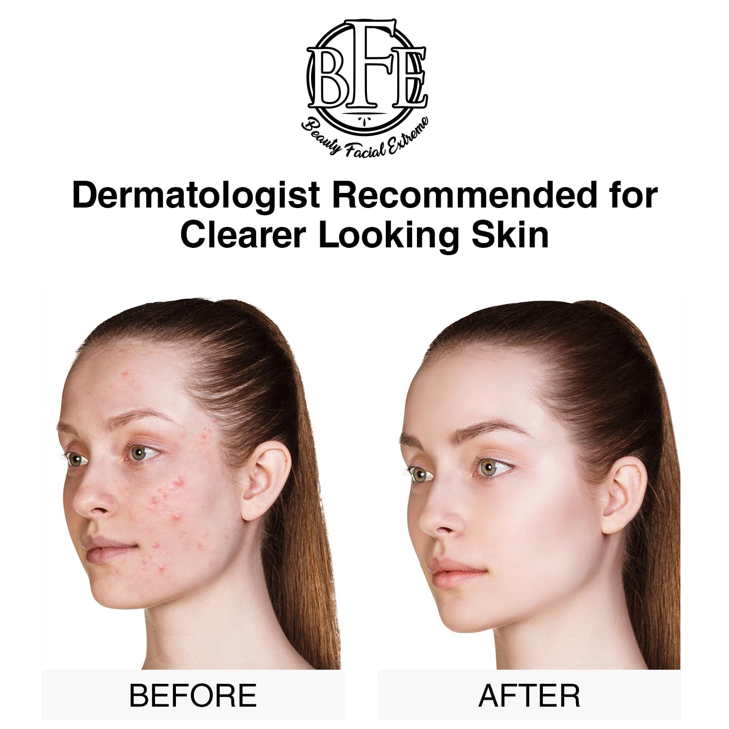 Acne Treatment Pads- Eliminates Cystic Breakouts, Oily Skin & Clogged Pores. Clear Pimple, Whitehead, Blackhead, Dark Spots & Improve Skin Texture.