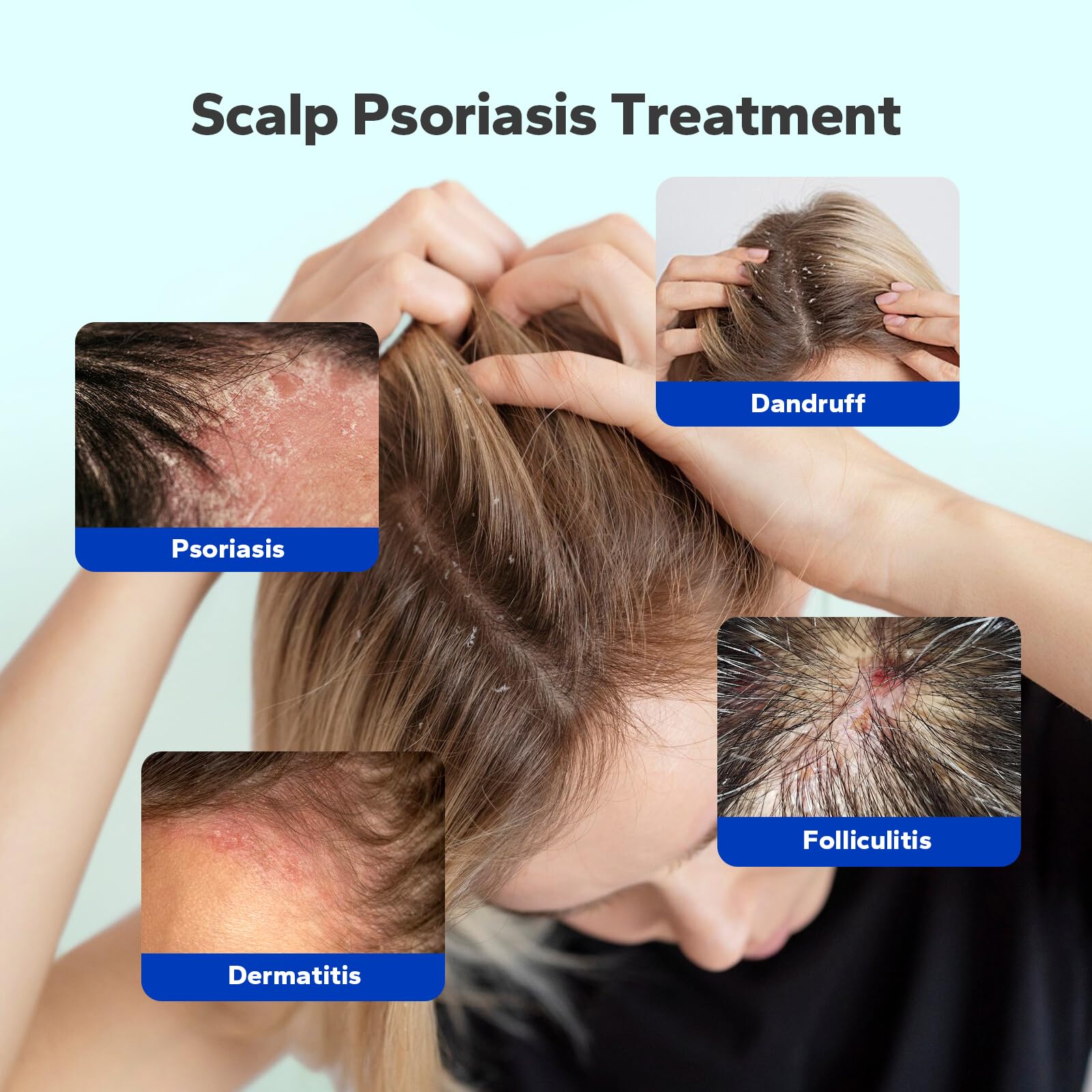 HyperHair Psoriasis Shampoo (8.45 Fl Oz), Medicated Shampoo with Salicylic Acid & Coconut Oil for Scalp Psoriasis, Seborrheic Dermatitis, Folliculitis & Dandruff, Anti-Itch, Flake-Free