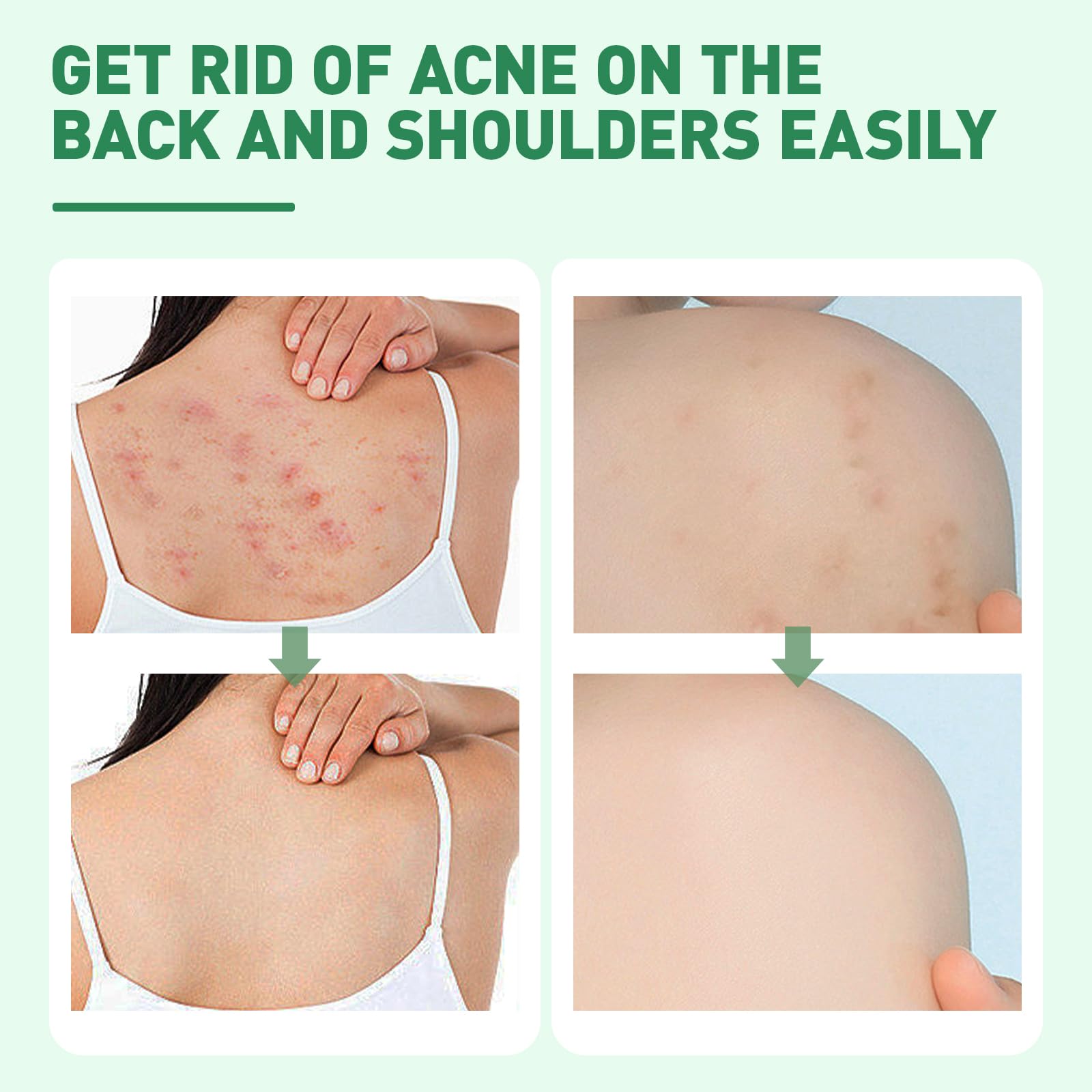 Back Acne Treatment With Herbal Formula, 2% Salicylic Acid & Tea Tree Oil - Body Spray Solution for Acne, 120ml (2PCS)