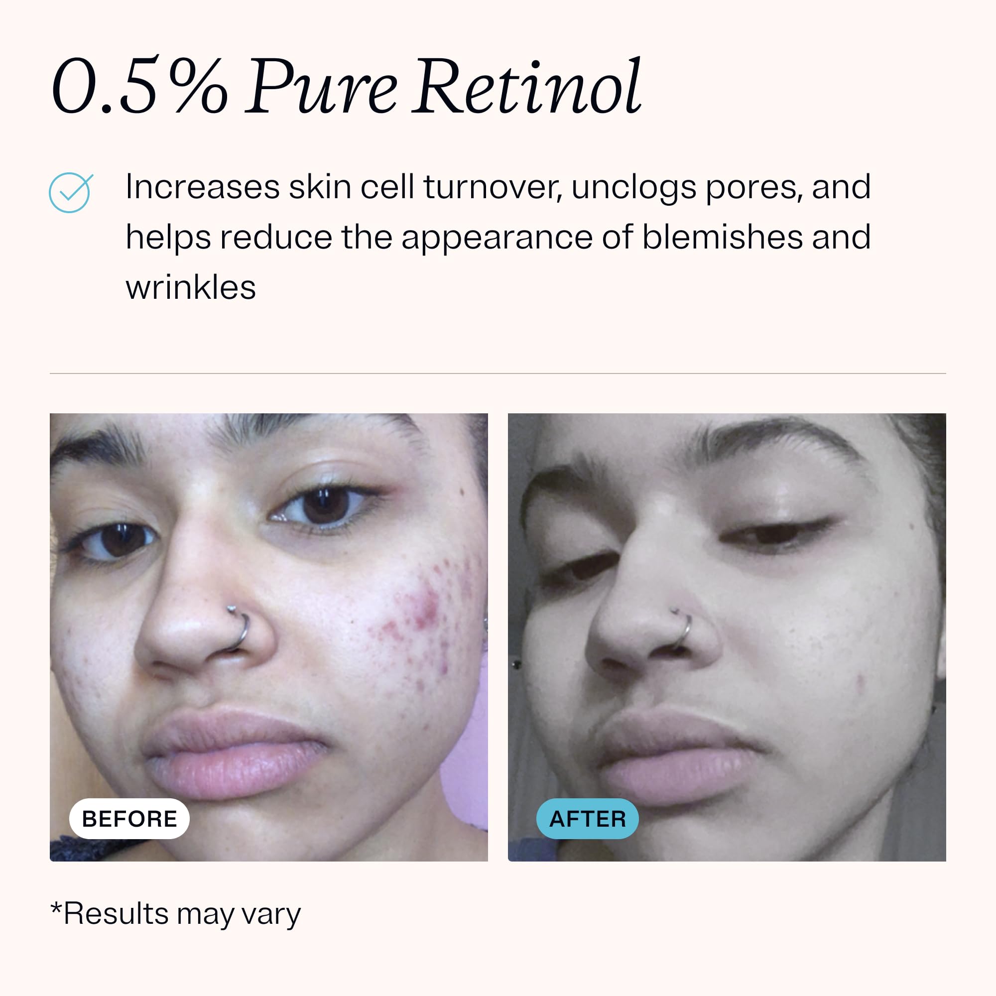 MDacne – Retinol 0.5% and Niacinamide 4% Cream, Reduces Blemishes and Improves Skin Texture without Irritation