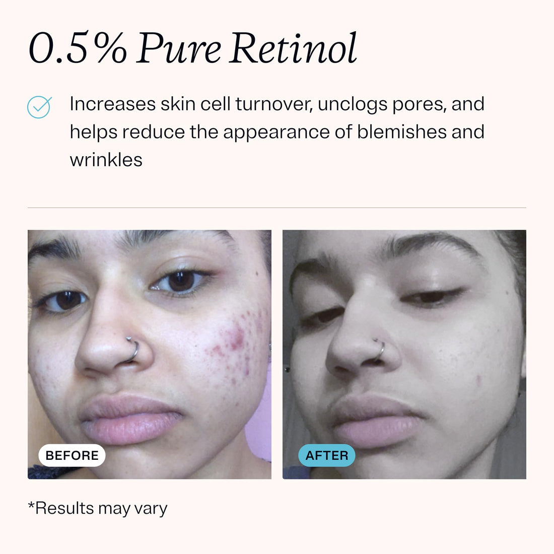 MDacne – Retinol 0.5% and Niacinamide 4% Cream, Reduces Blemishes and Improves Skin Texture without Irritation