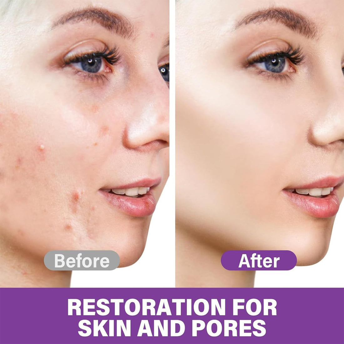 Azelaic Acid 12% Facial Serum with Hyaluronic Acid & Niacinamide, Azelaic Acid Serum for Reducing Blemish & Rosacea Acne, Prevents Acne Breakouts, Ease Pimple Clarify Skin Soothe Irritation
