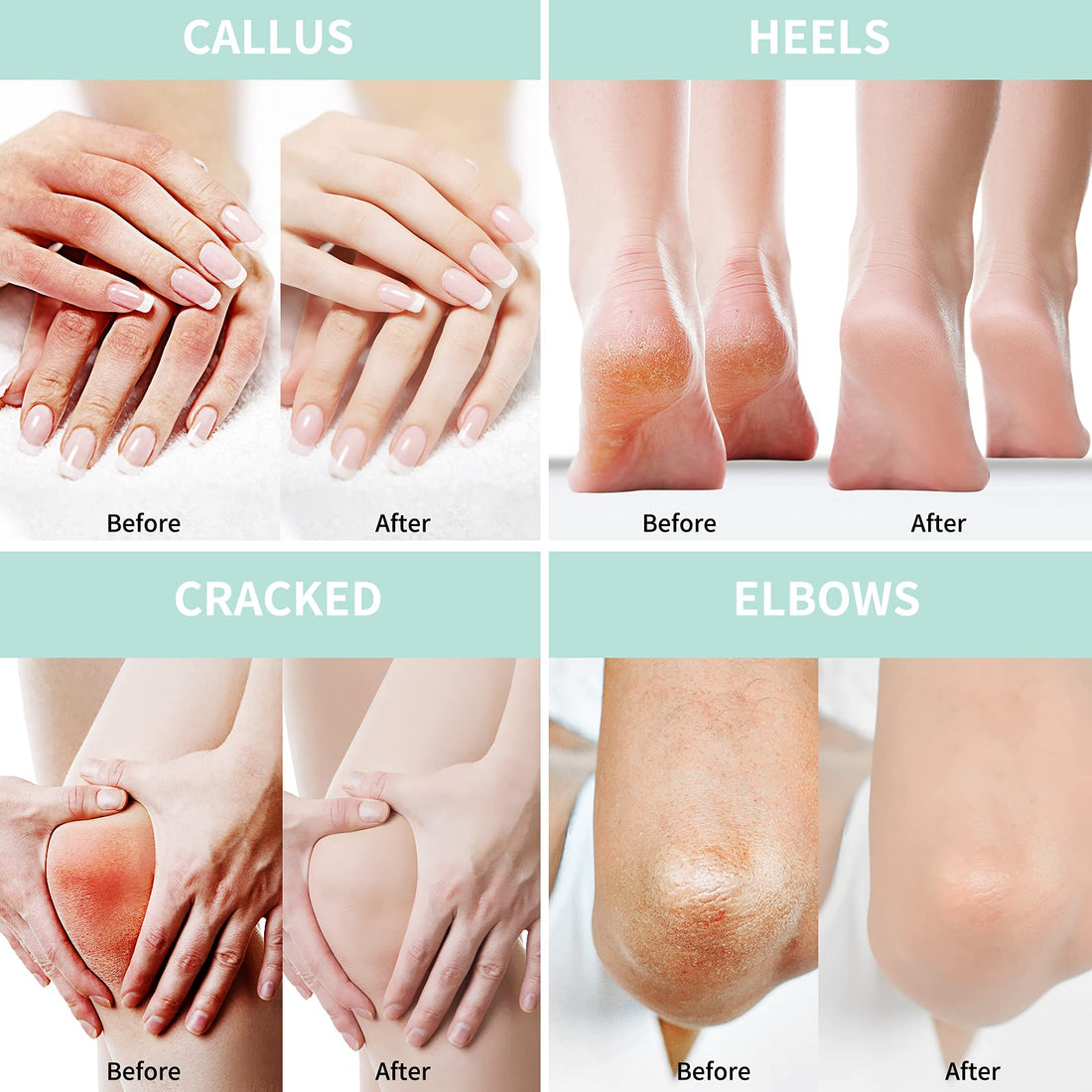 Grocerism Urea Cream 40 Percent For Feet Plus 2% Salicylic Acid 5.29 oz || Foot Cream and Hand Cream Maximum Strength with Hyaluronic Acid,Tea Tree,and Aloe Vera For Deep Moisturizes,Callus Remover