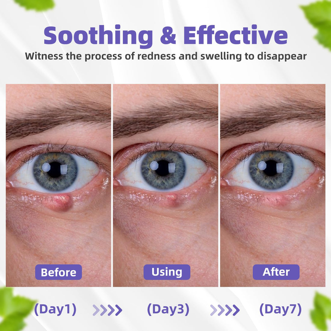 Stye Eye Treatment, Natural Relief Drops Serum for Styes Chalazion and Blepharitis, Fast Chalazion Remover for Restore Healthier Eye Skin (1 Floz) (1 Fl Oz (Pack of 1), Original)