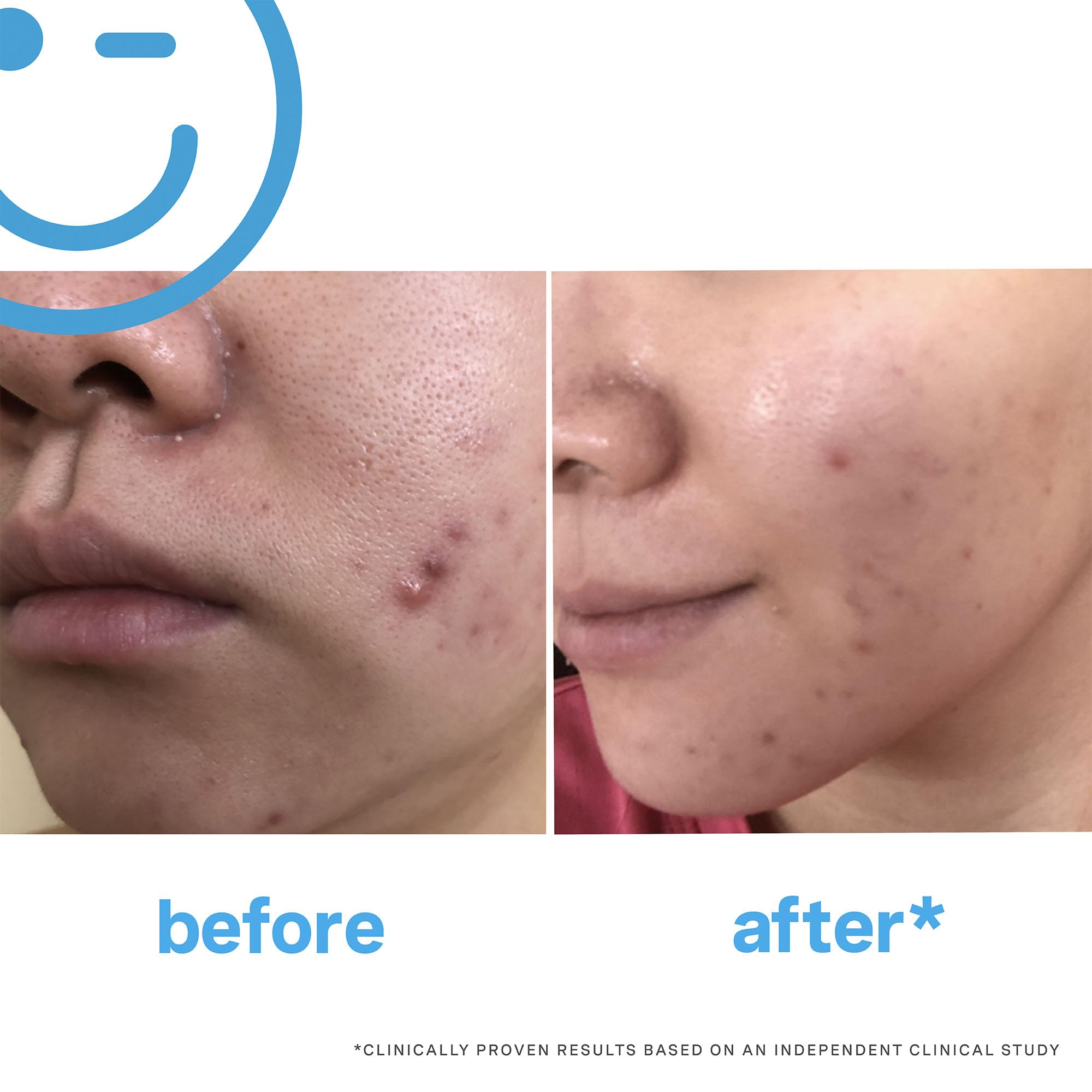 Kate Somerville Eradikate Daily Foaming Cleanser - Acne Face Wash For Visibly Clearer Skin (4 Fl. Oz.)