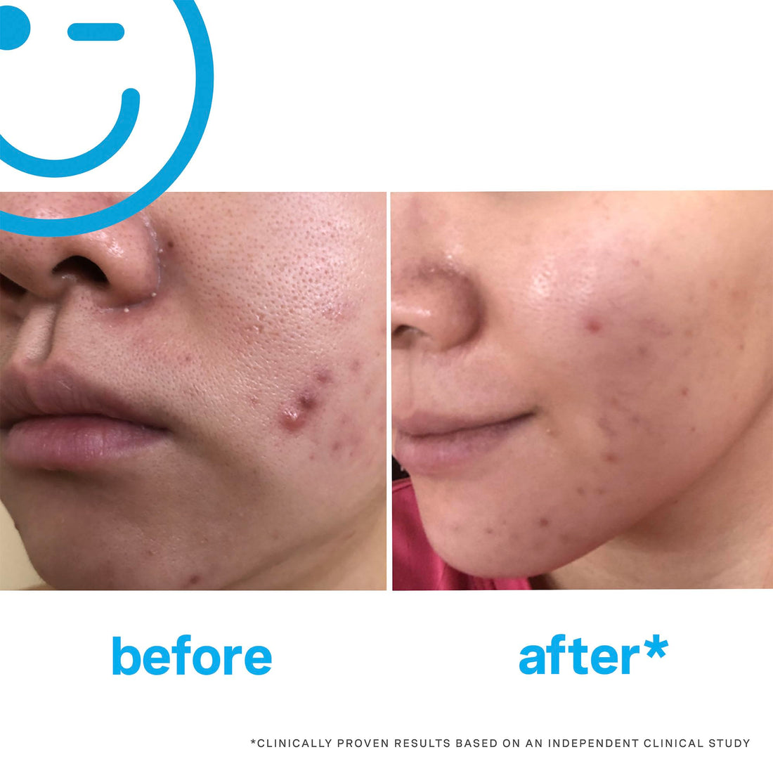 Kate Somerville Eradikate Daily Foaming Cleanser - Acne Face Wash For Visibly Clearer Skin (4 Fl. Oz.)