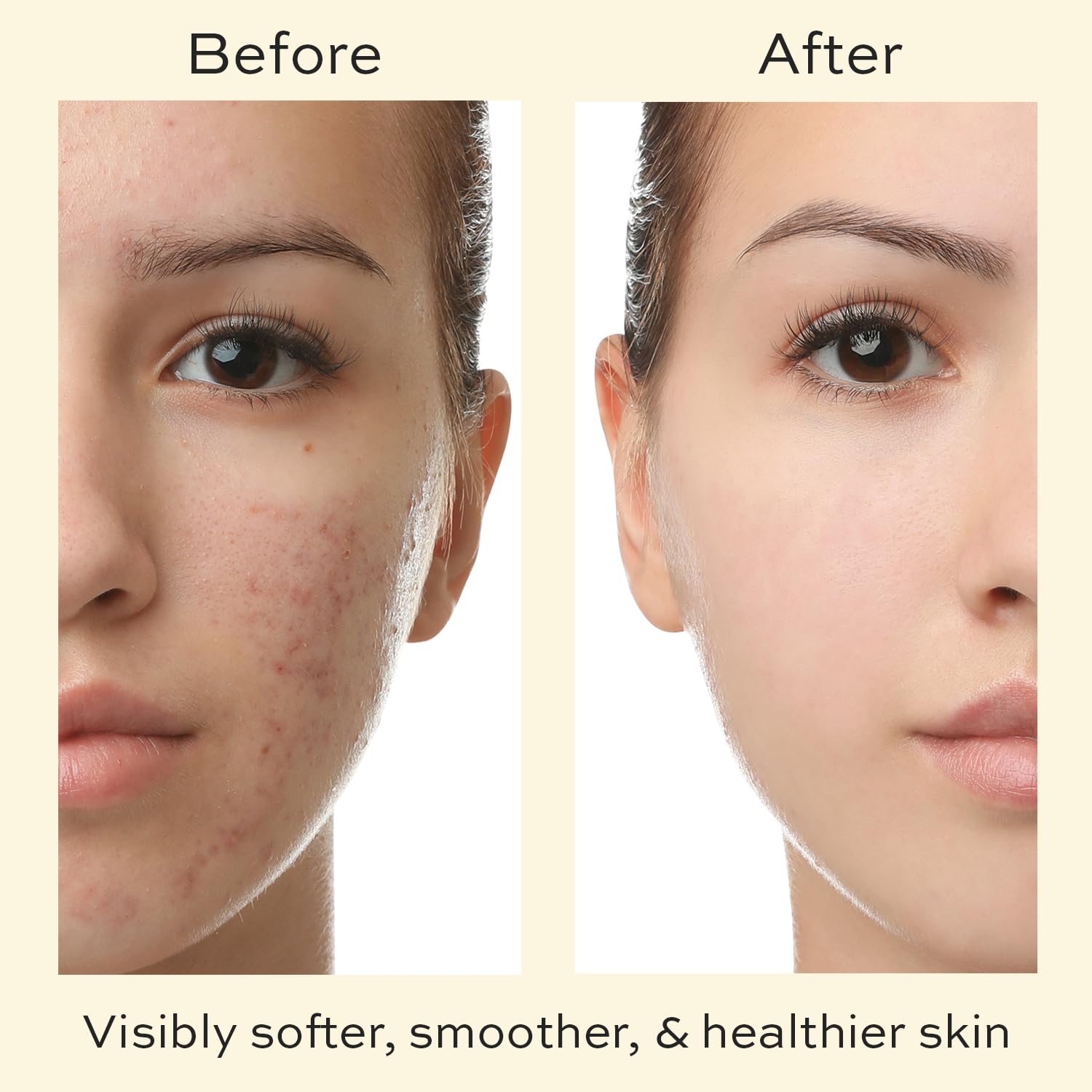 Skin Care for Teenage Boys and Girls - Teen Moisturizer for Face with Tea Tree - Organic Face Cream for Oily Skin - Daily Acne Treatment for Teenagers - Soothing Hyaluronic Acid Moisturizer