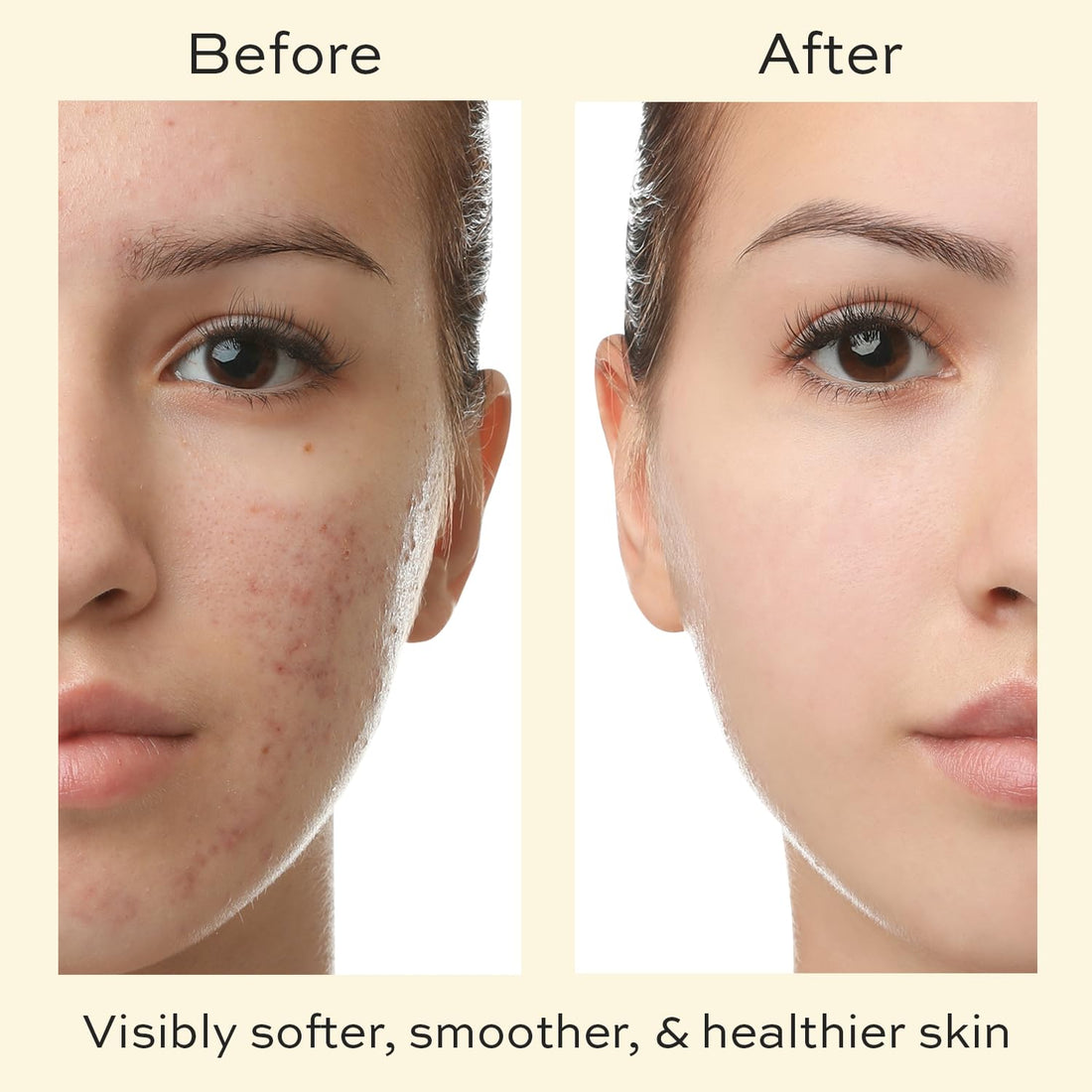 Skin Care for Teenage Boys and Girls - Teen Moisturizer for Face with Tea Tree - Organic Face Cream for Oily Skin - Daily Acne Treatment for Teenagers - Soothing Hyaluronic Acid Moisturizer